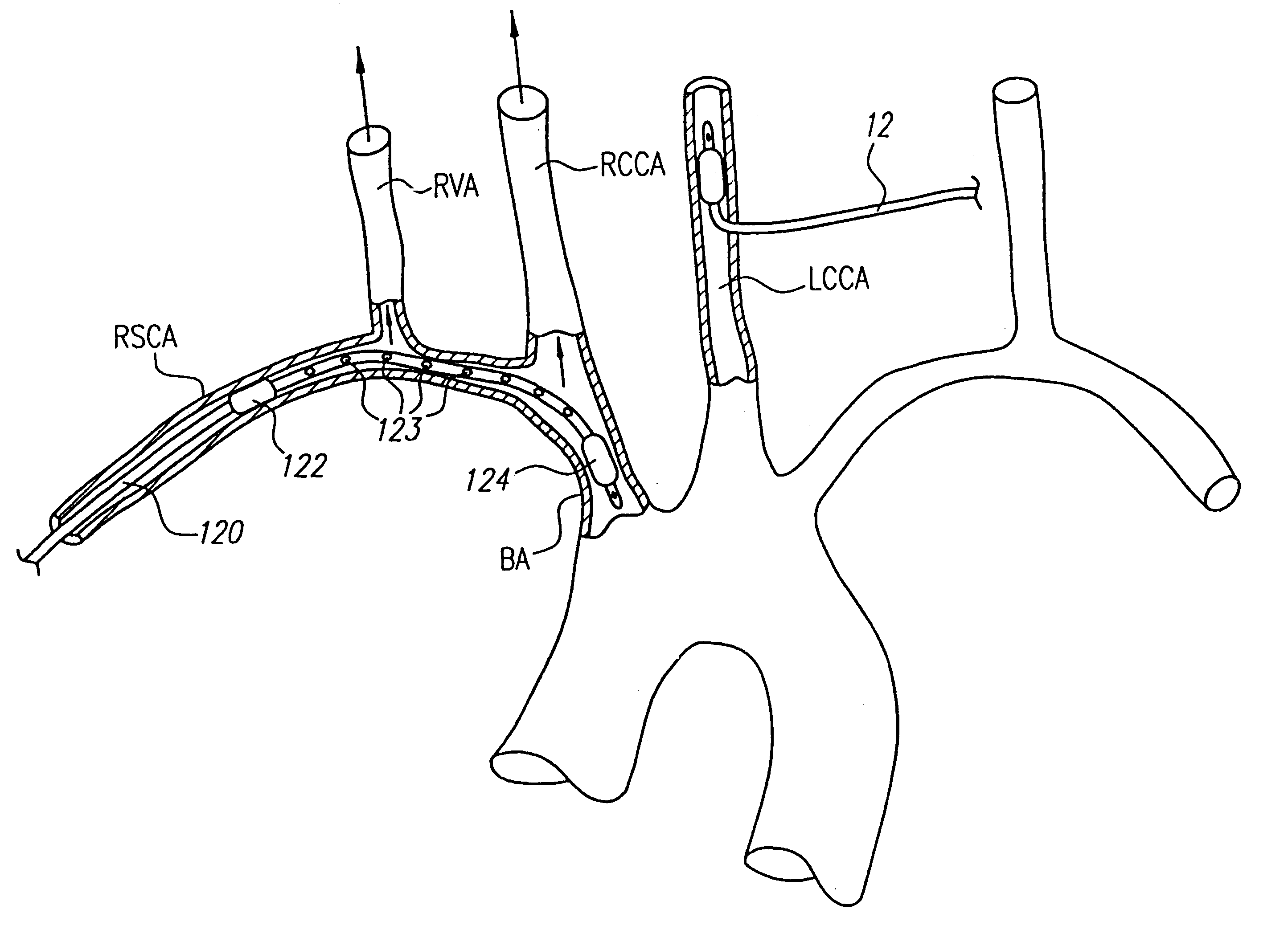 Method and system for selective or isolated integrate cerebral perfusion and cooling