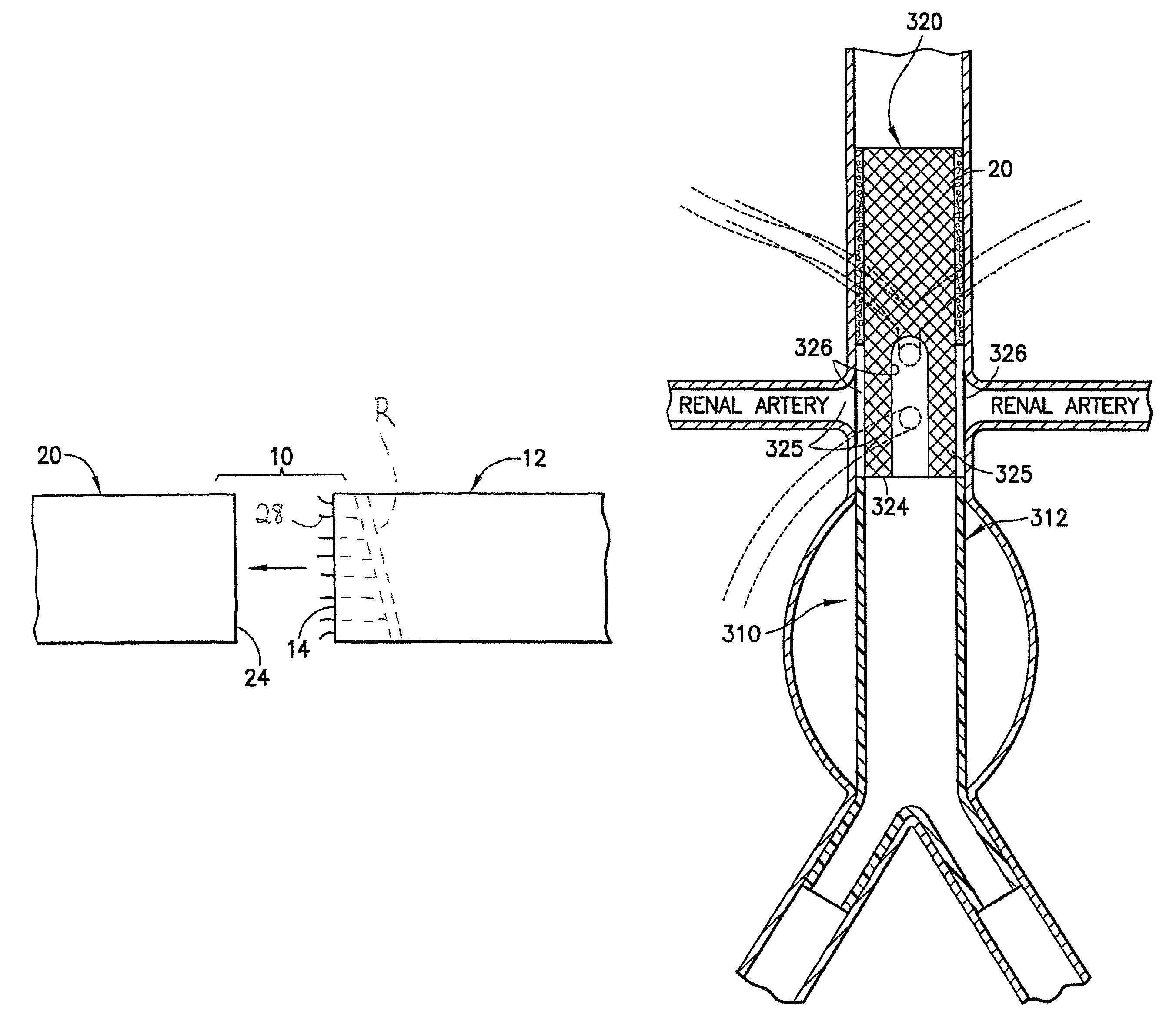 Stent/graft assembly