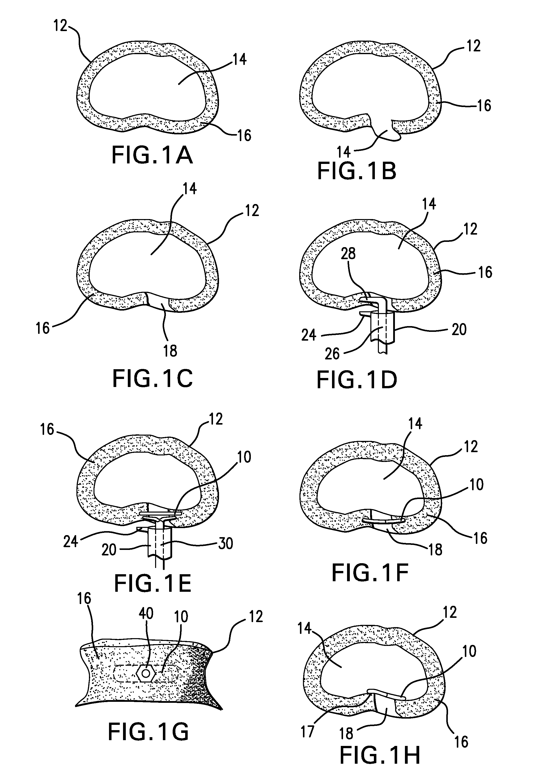 Annular repair device and method