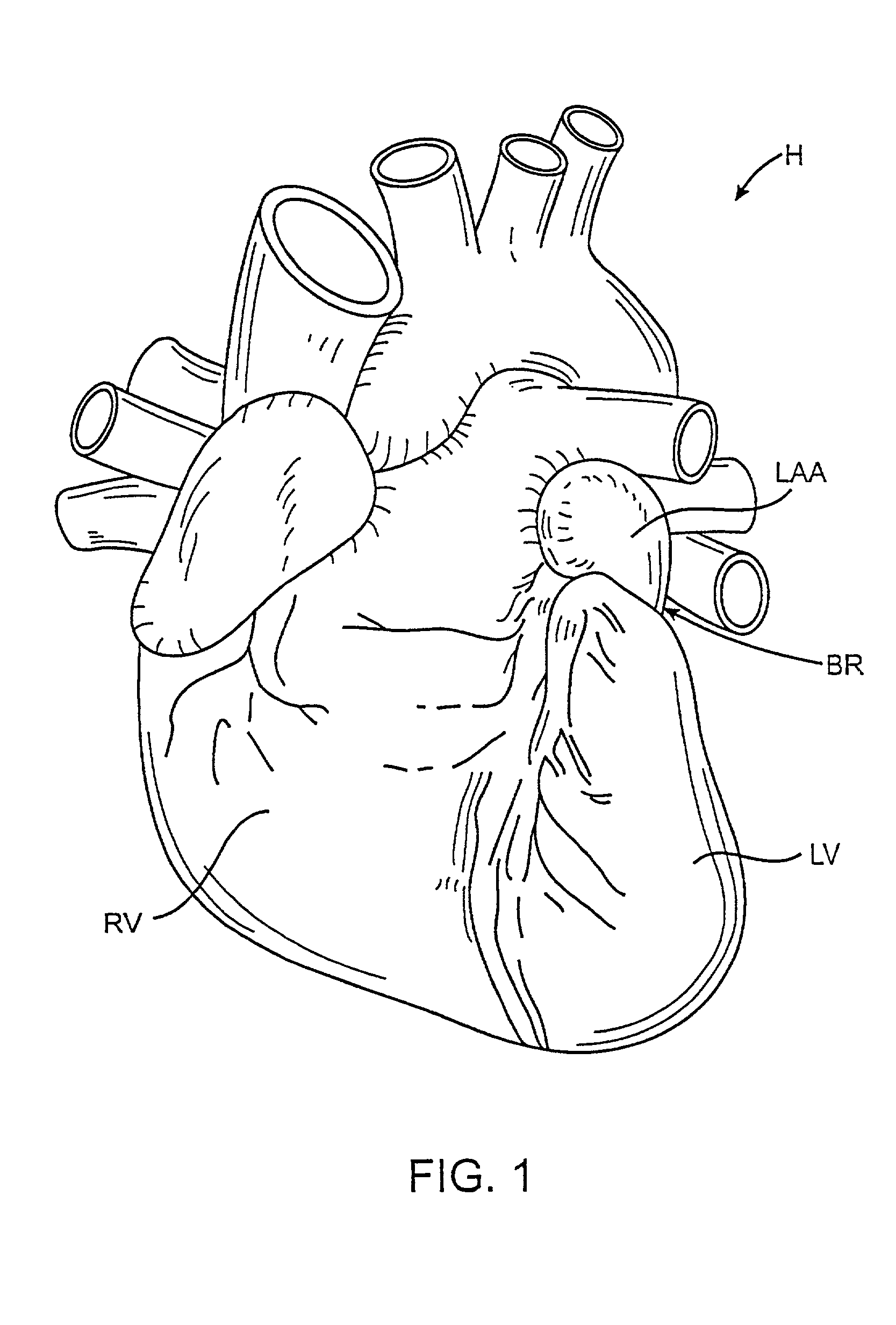 Methods and apparatus for transpericardial left atrial appendage closure