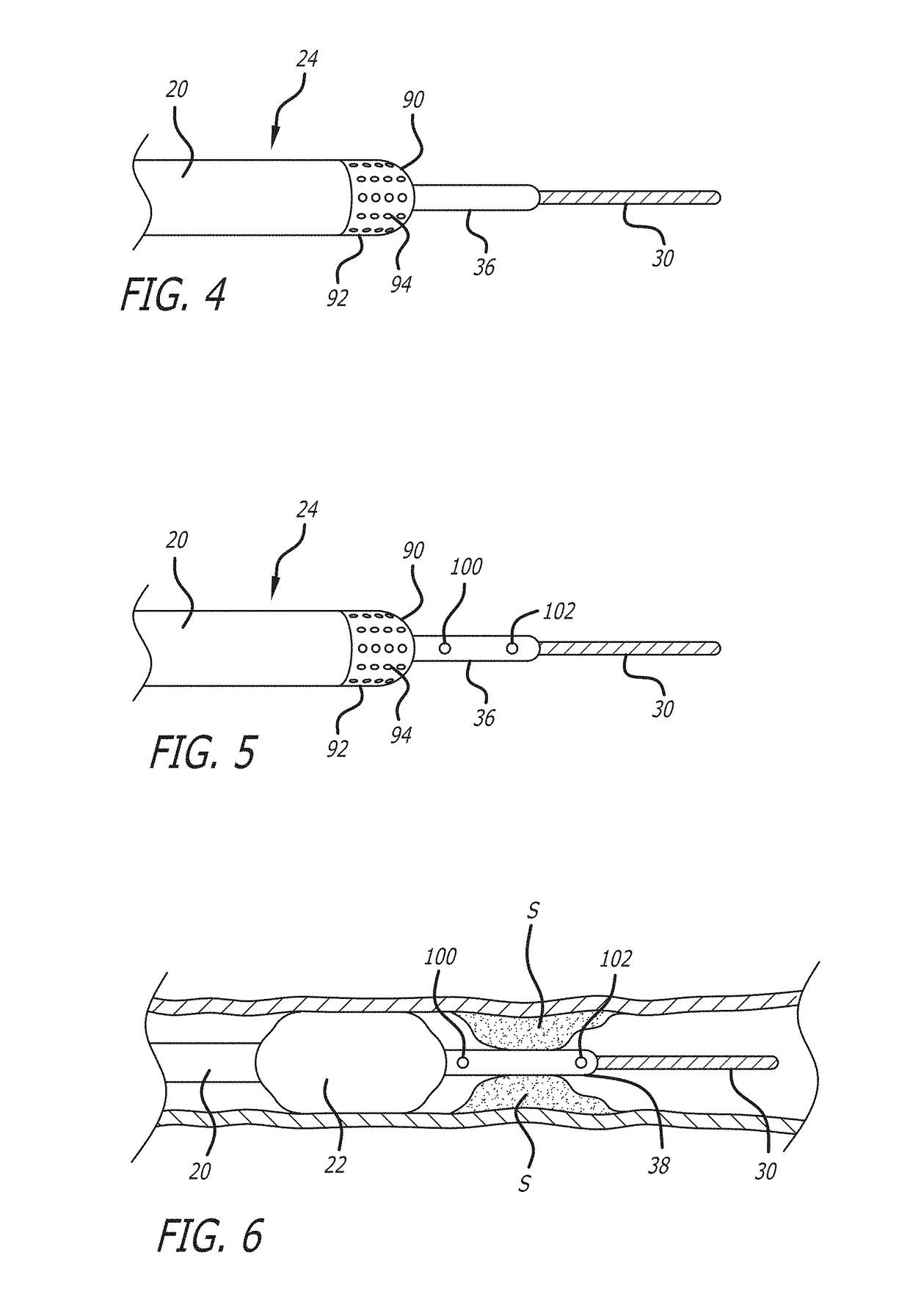 System and methods for treating mvo