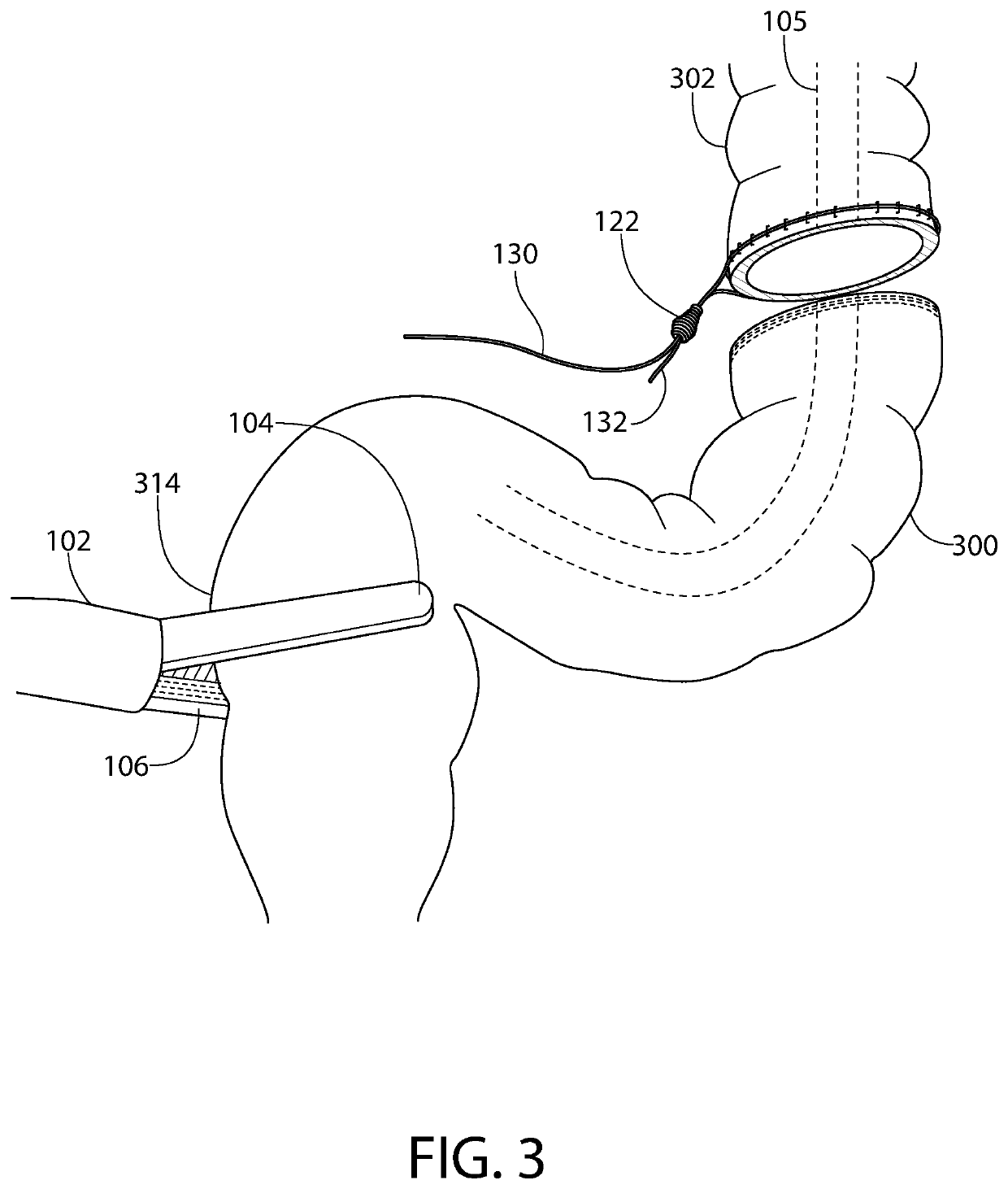 Devices and methods for minimally invasive surgical procedures