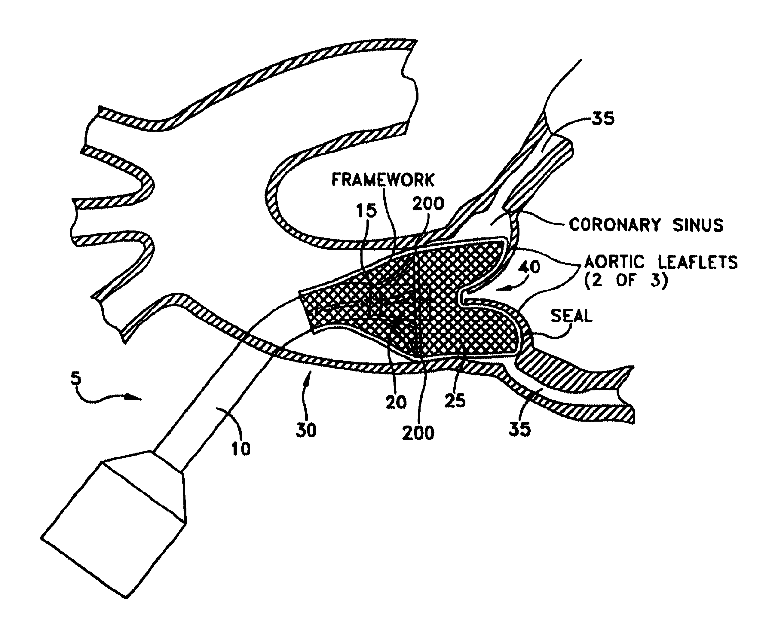 Apparatus and method for replacing aortic valve