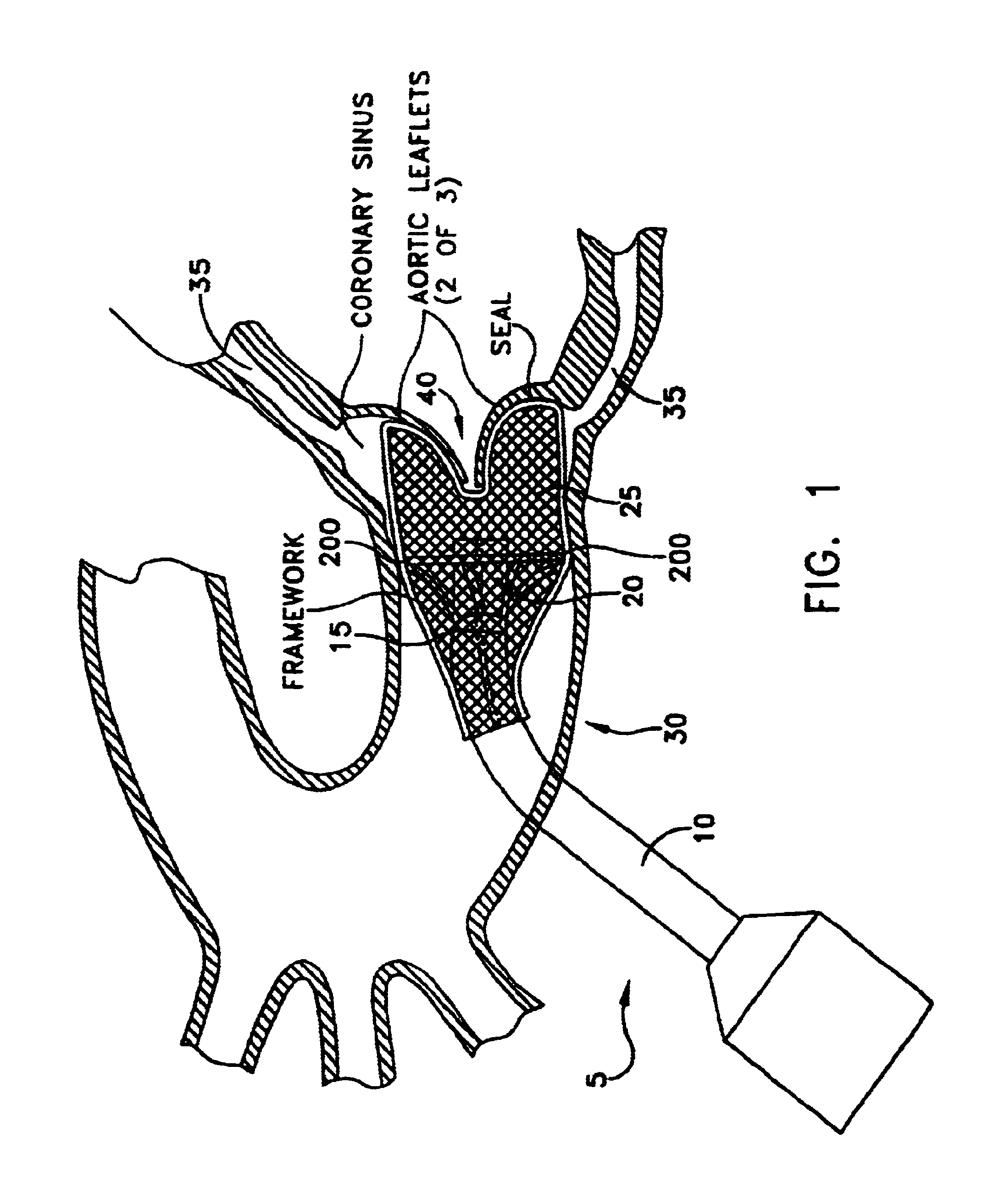 Apparatus and method for replacing aortic valve
