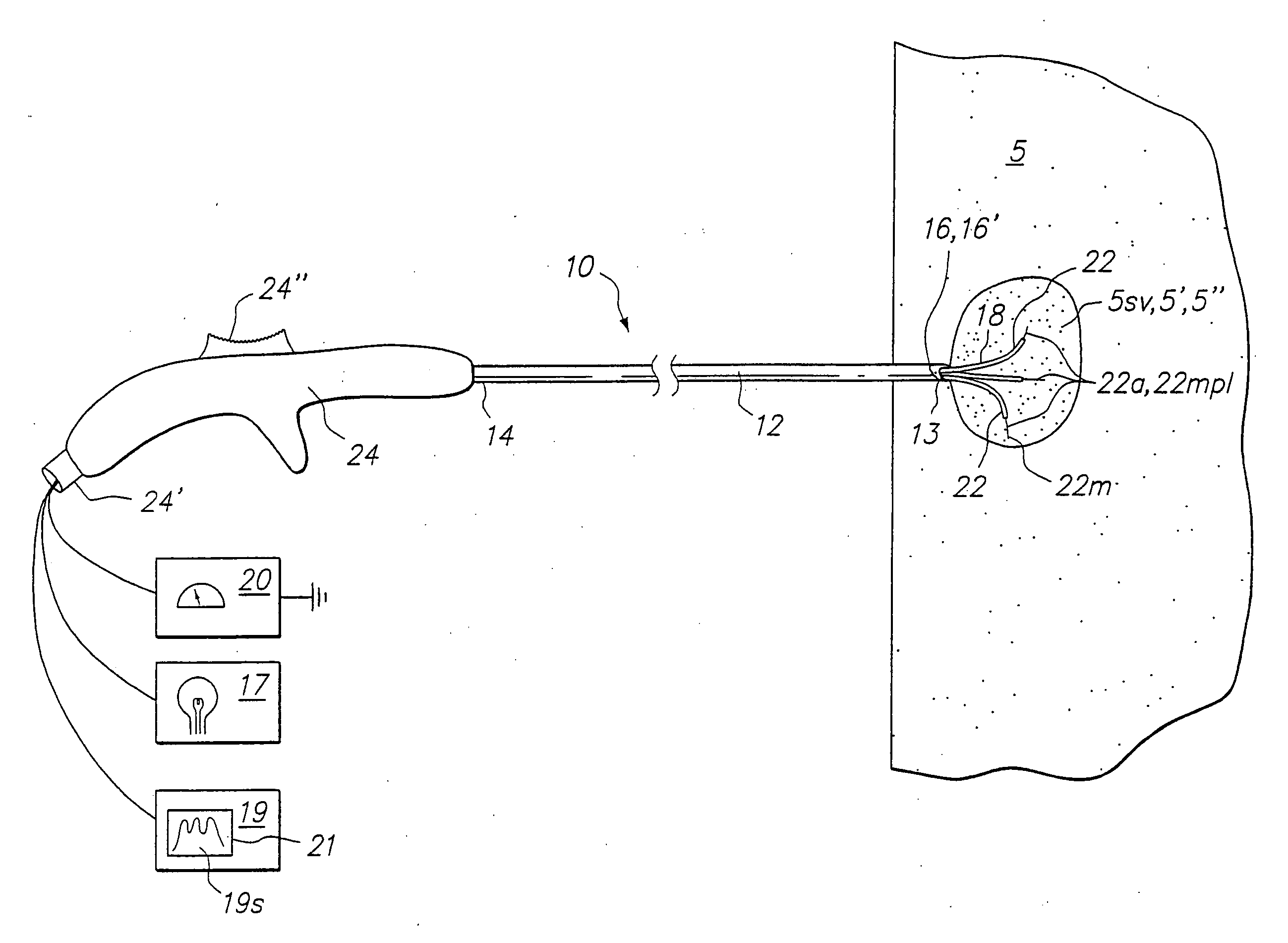 Tissue biopsy and treatment apparatus and method