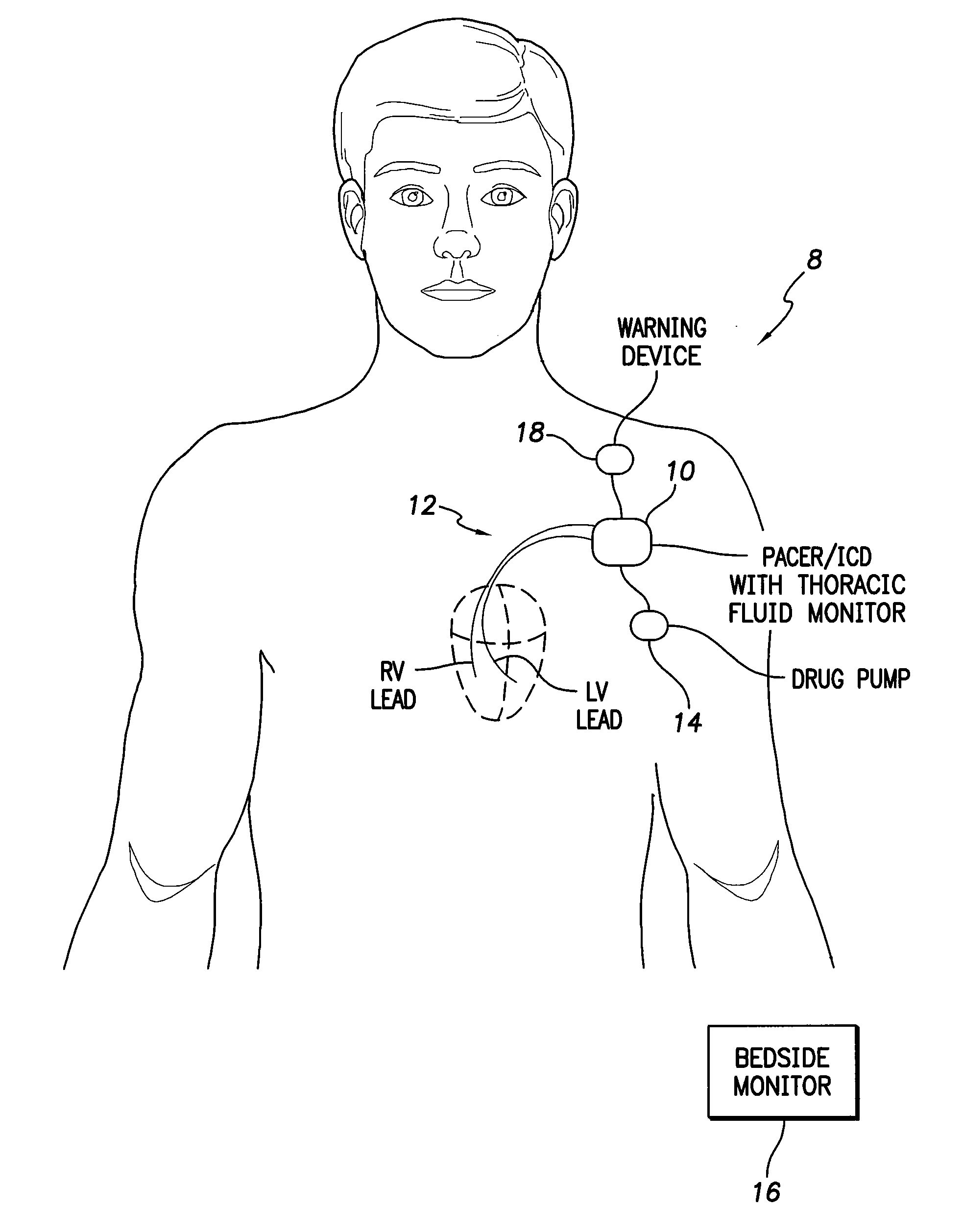 System and method for monitoring thoracic fluid levels based on impedance using an implantable medical device