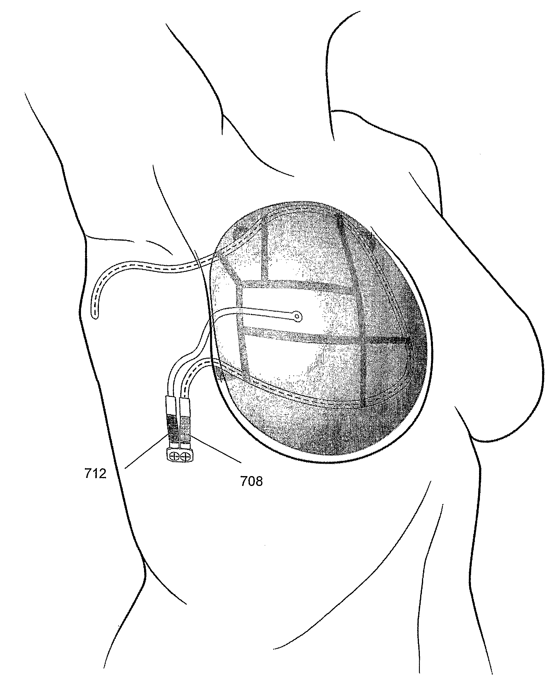 Methods and devices for breast reconstruction