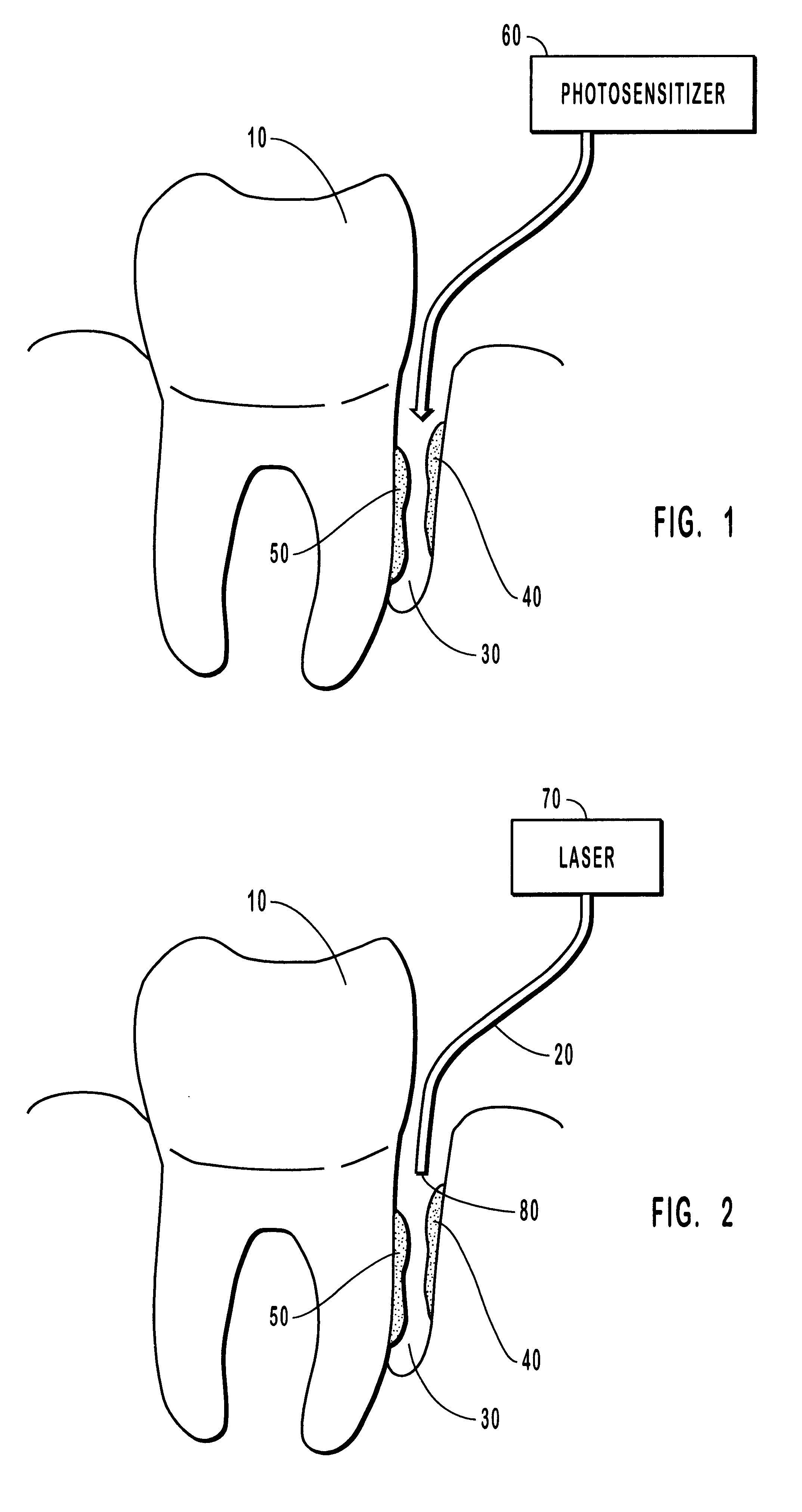 Methods for treating periodontal disease