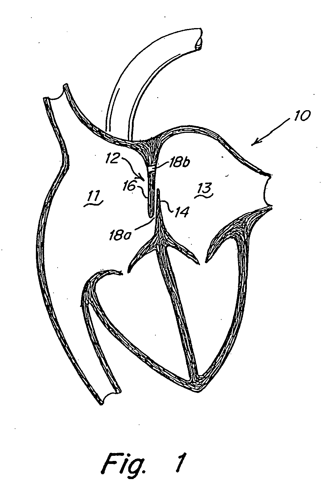 Patent foramen ovale (PFO) closure device with linearly elongating petals