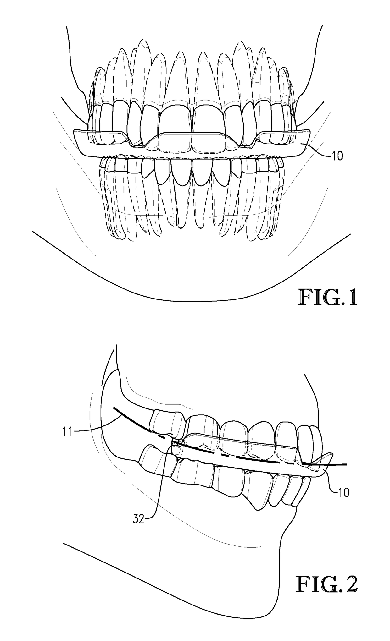 Custom-fit dental guard