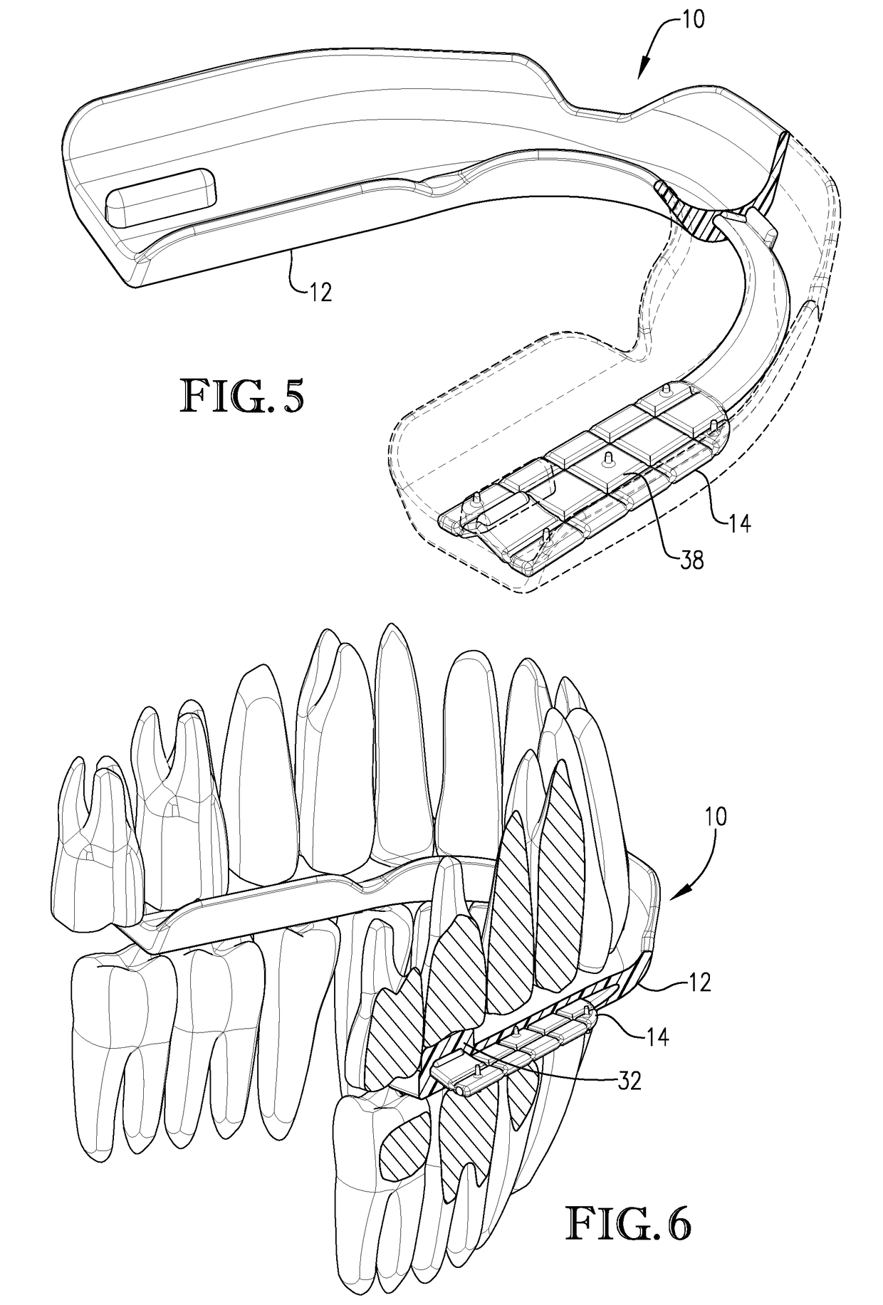 Custom-fit dental guard