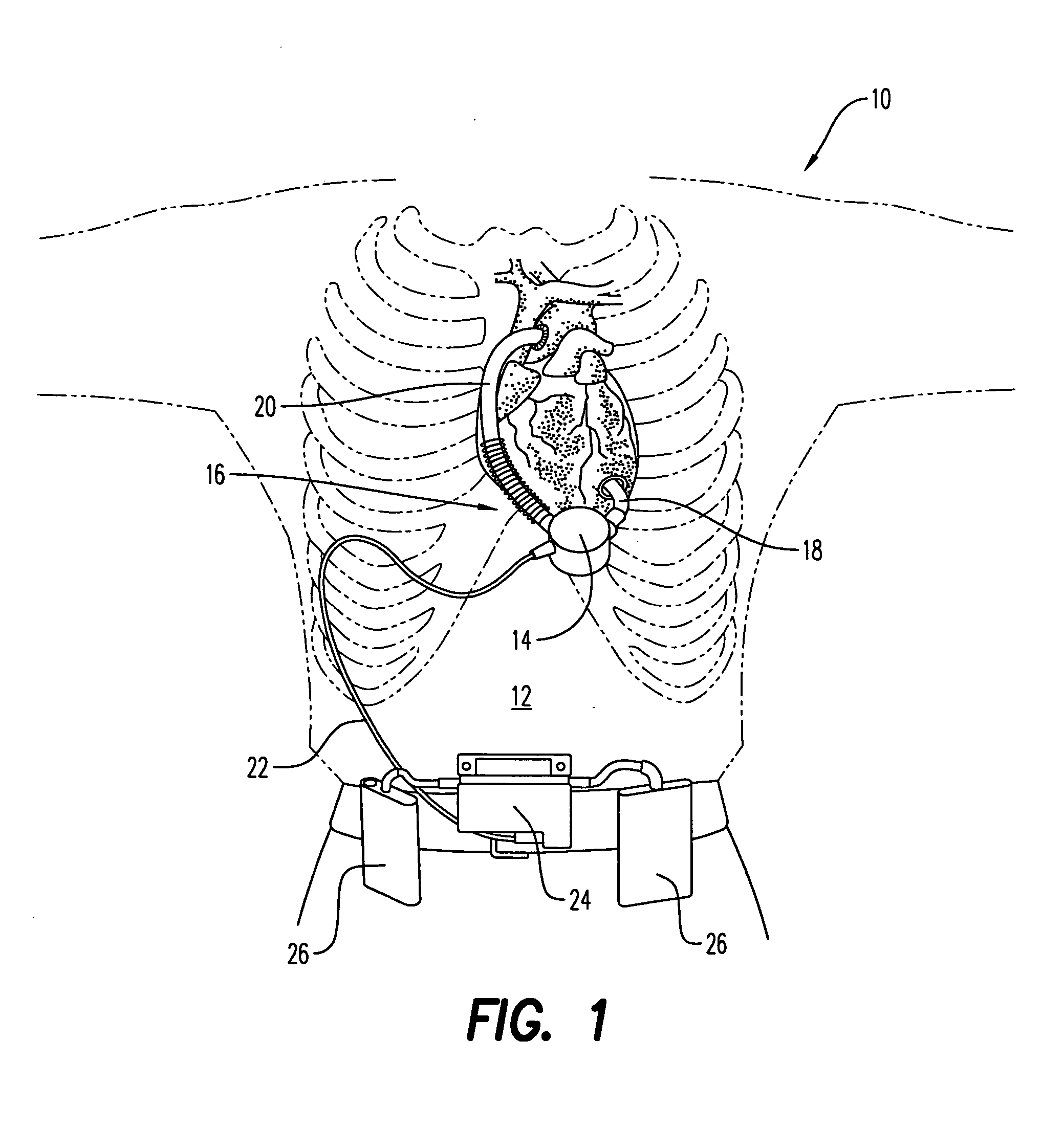 Adjustable coupling mechanism for the conduit on a ventricular assist device
