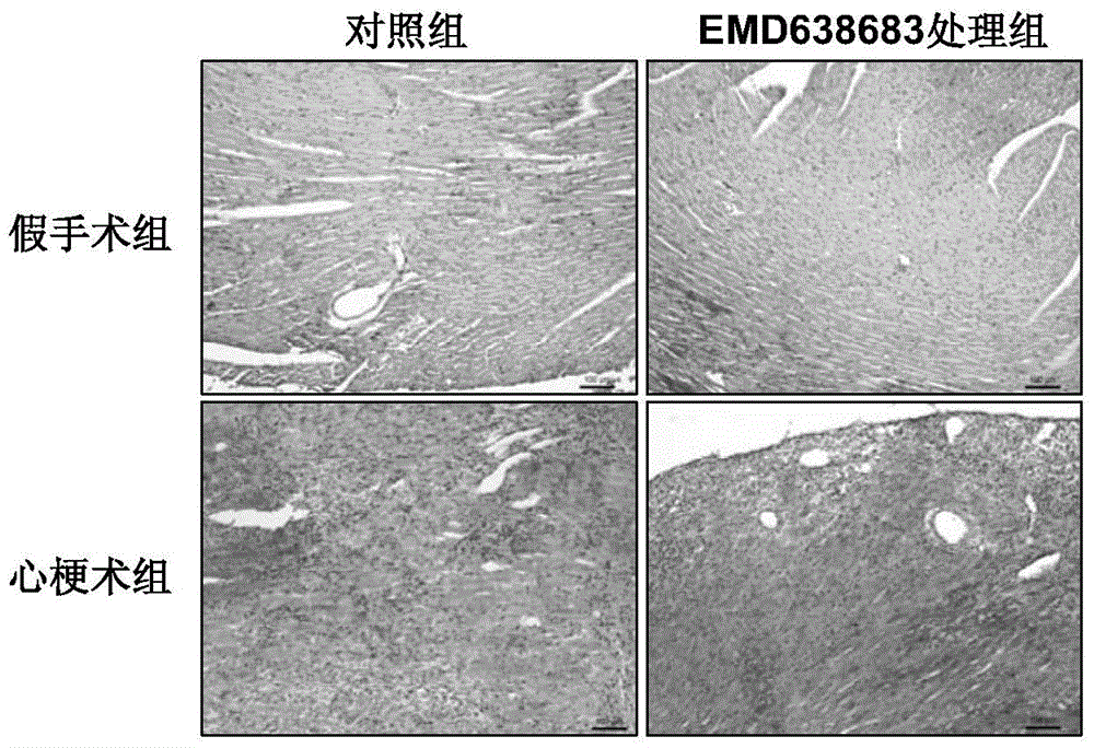 Application of novel SGK1 inhibitor EMD638683 in preparation of drug used for treating acute myocardial infarction