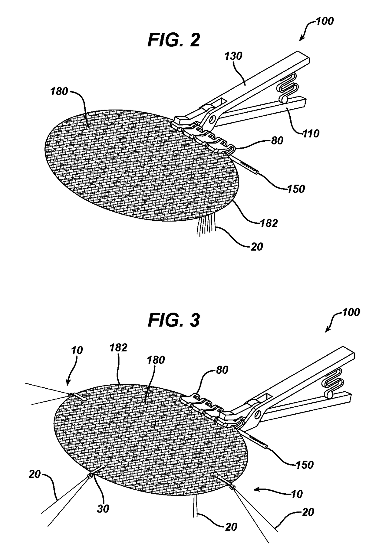 Method and means to attach anchor suture onto mesh implants