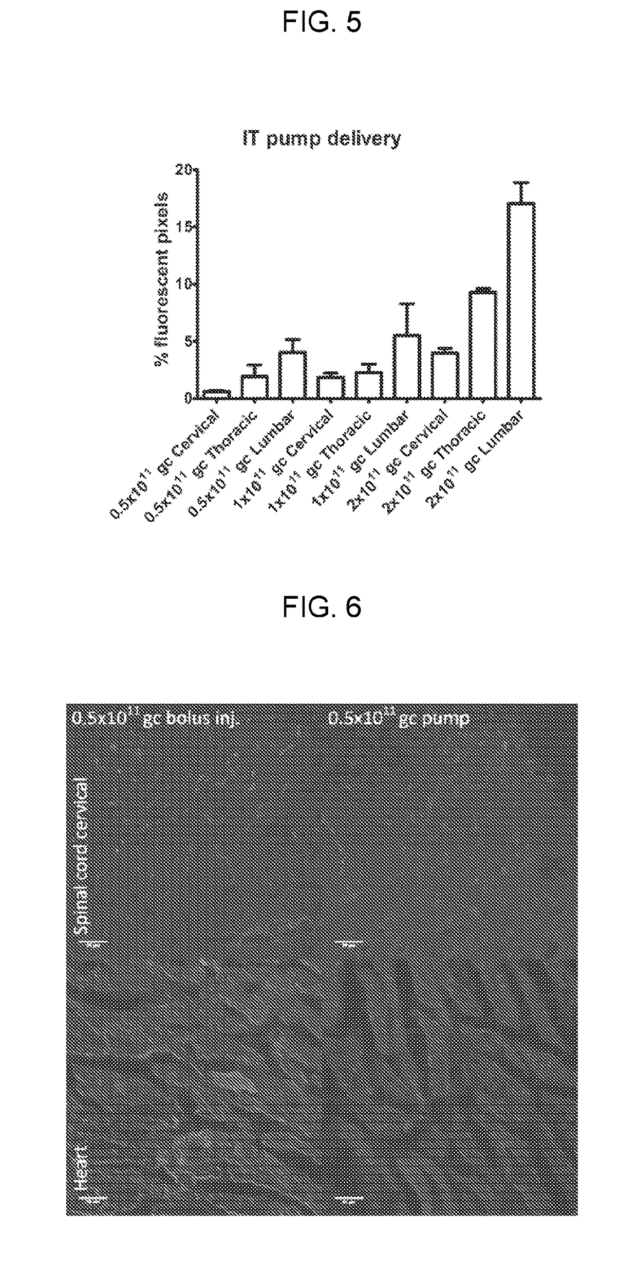 Intrathecal delivery of nucleic acid sequences encoding abcd1 for treatment of adrenomyeloneuropathy