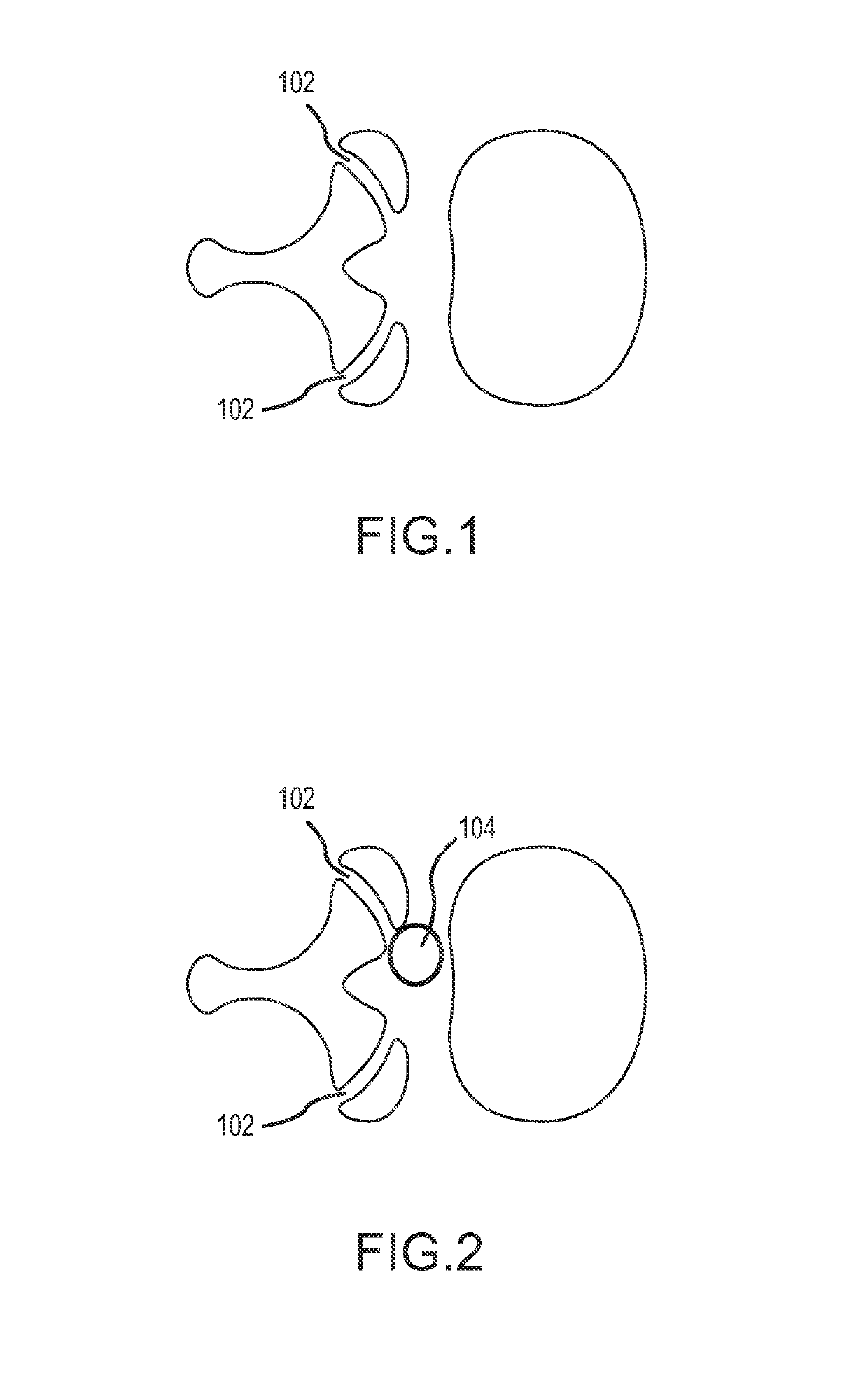 Devices, kits and methods relating to treatment of facet joints