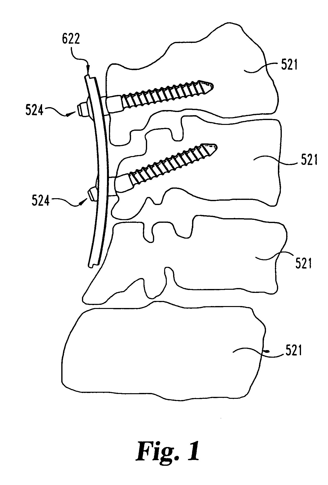 Multi-axial bone anchor system