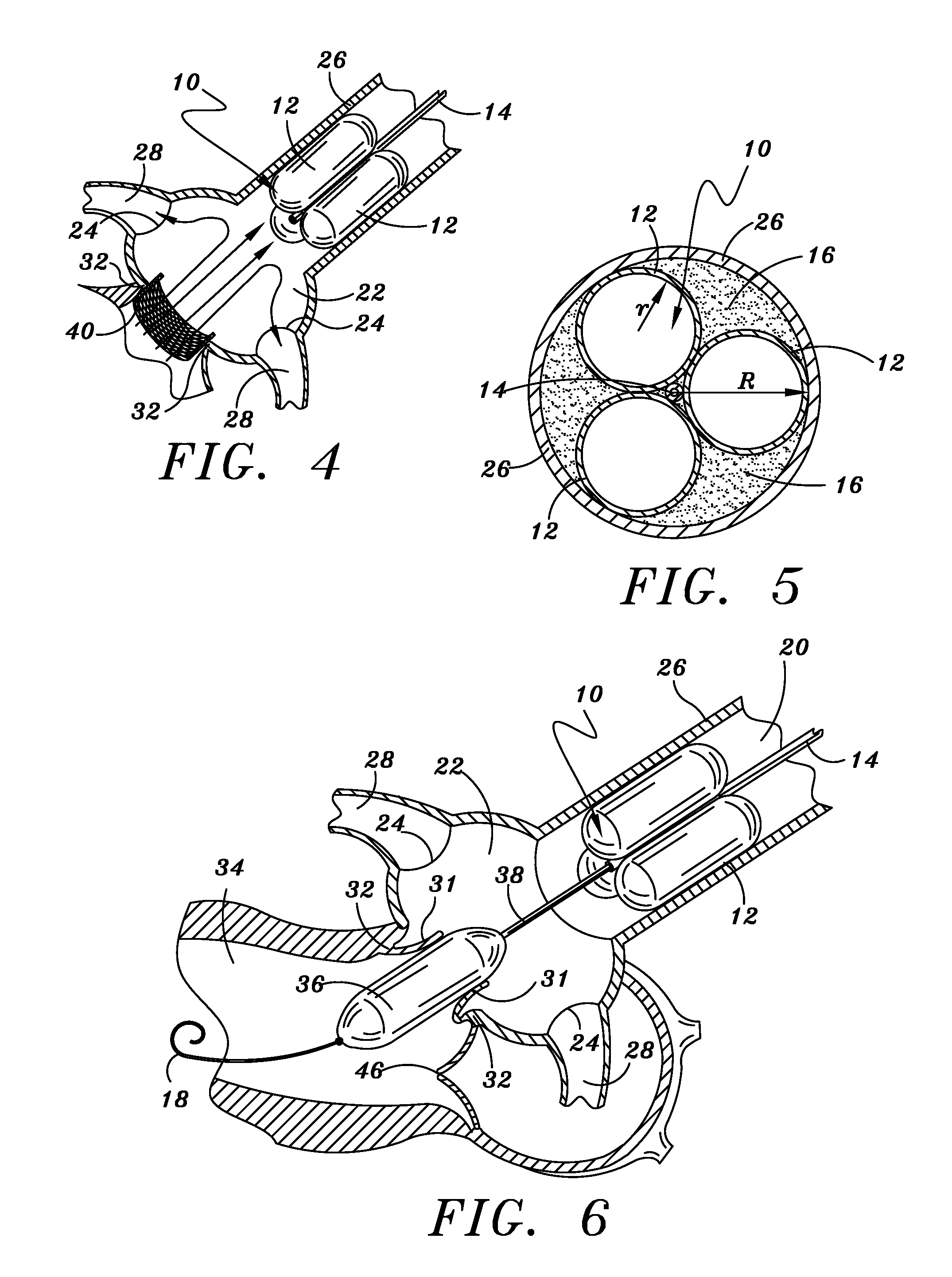Methods and apparatus for percutaneous aortic valve replacement