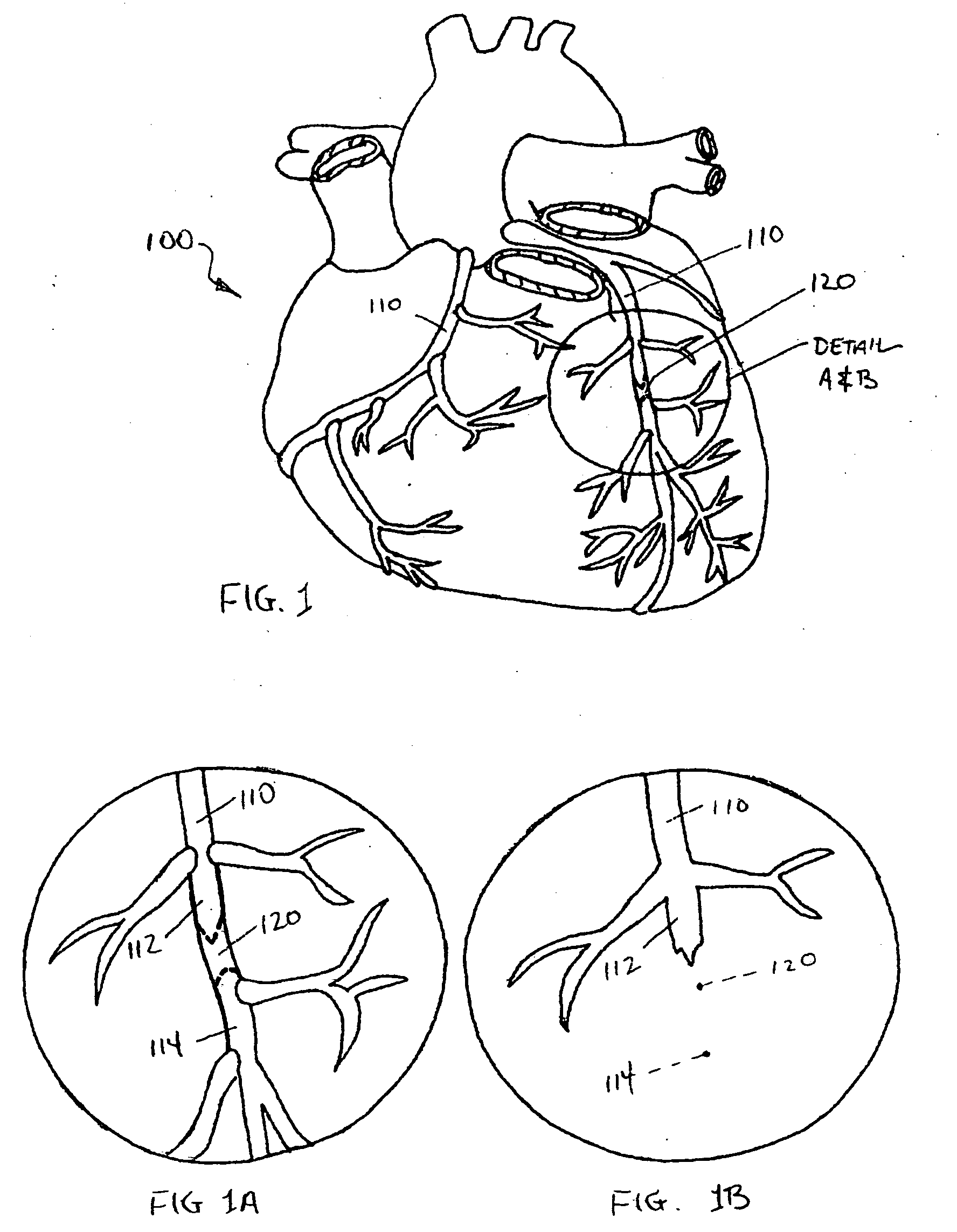 Endovascular devices and methods for exploiting intramural space