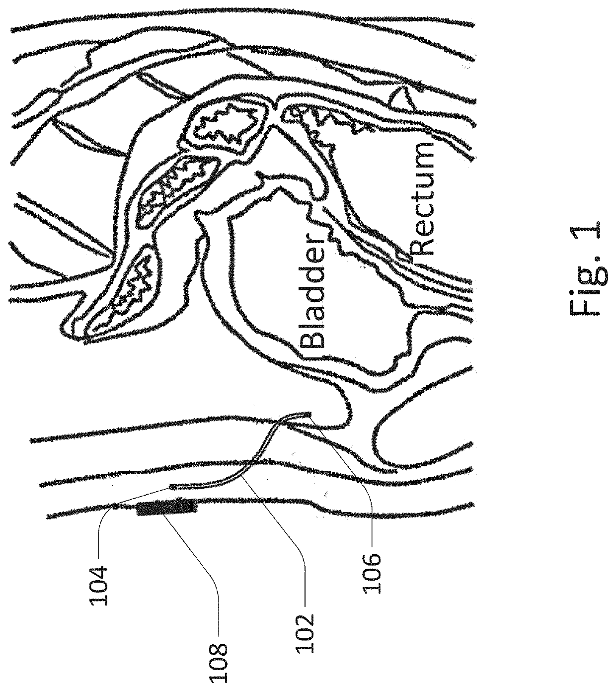 Methods and devices for fluid delivery and analyte sensing via an implantable port