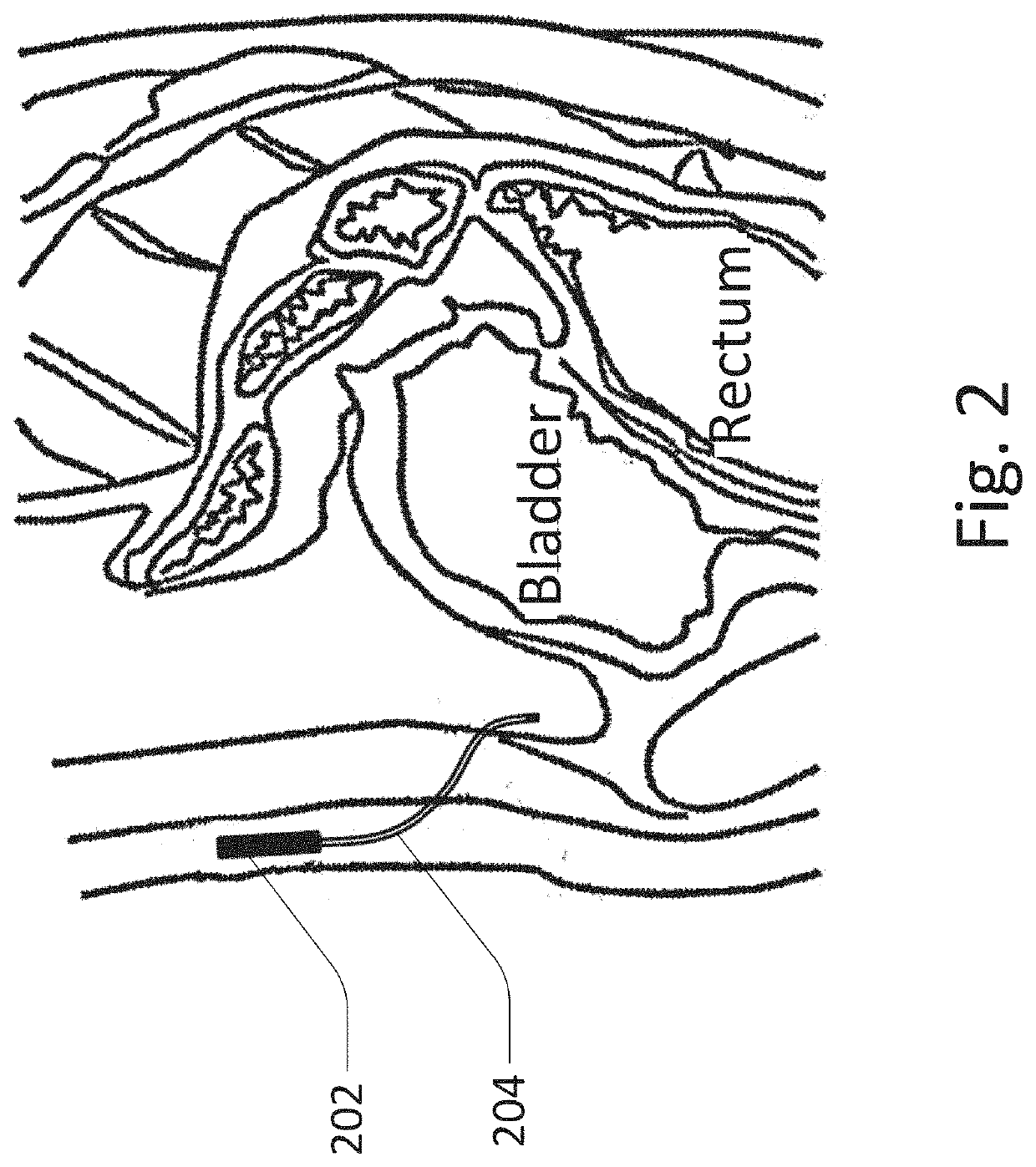 Methods and devices for fluid delivery and analyte sensing via an implantable port