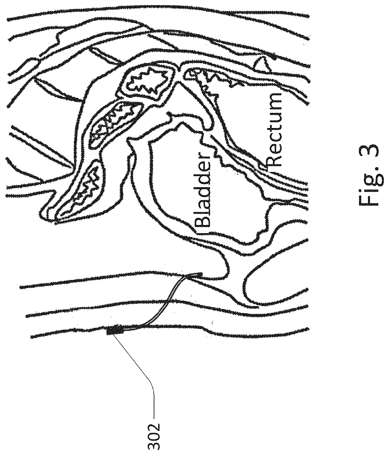 Methods and devices for fluid delivery and analyte sensing via an implantable port