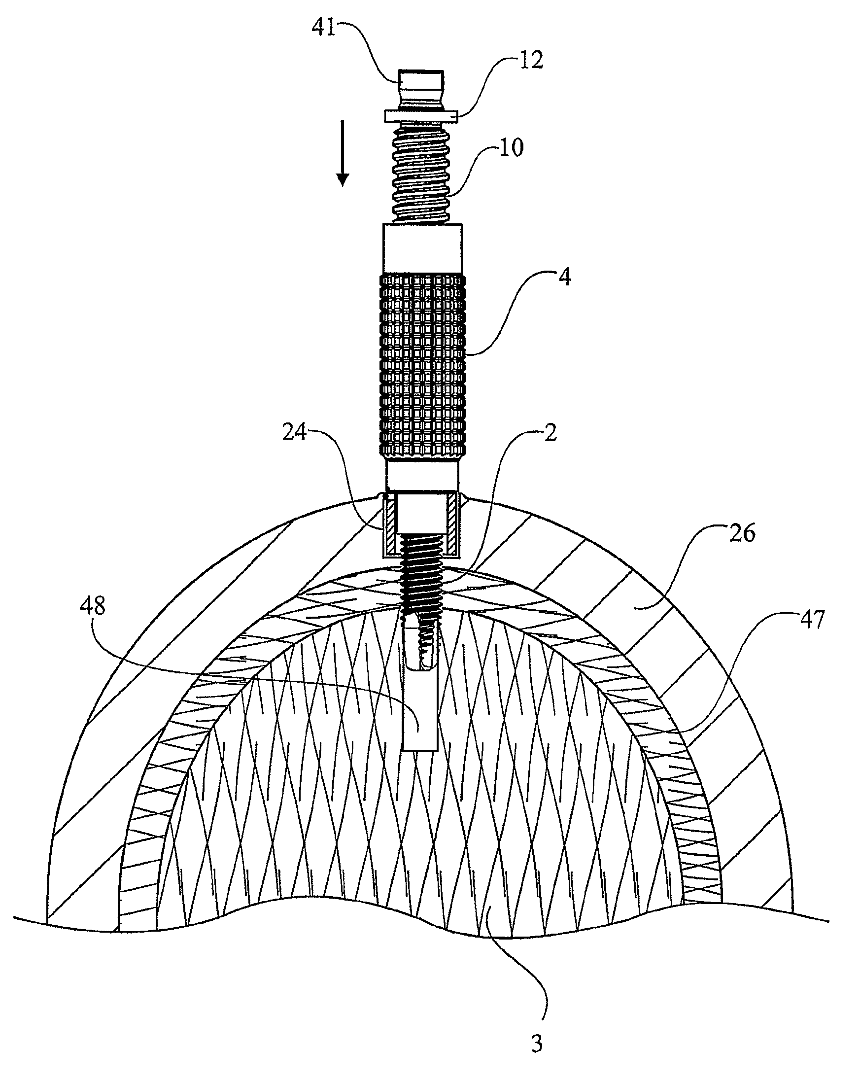 Device for securing a dental implant in bone tissue, a method for making a surgical template and a method of securing a dental implant in bone tissue