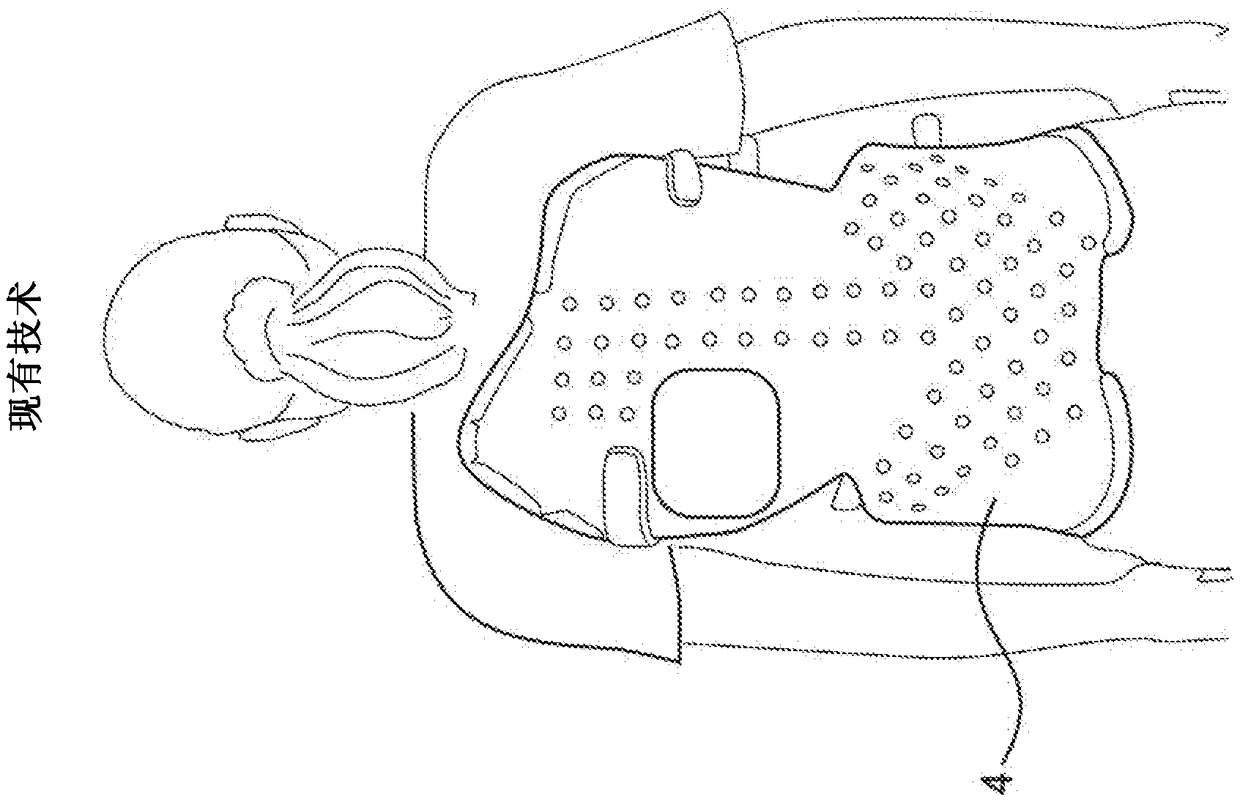 Subcutaneous implantable device for gradually aligning a spine and subcutaneous implantable device for gradually lengthening a bone