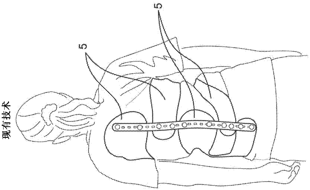 Subcutaneous implantable device for gradually aligning a spine and subcutaneous implantable device for gradually lengthening a bone