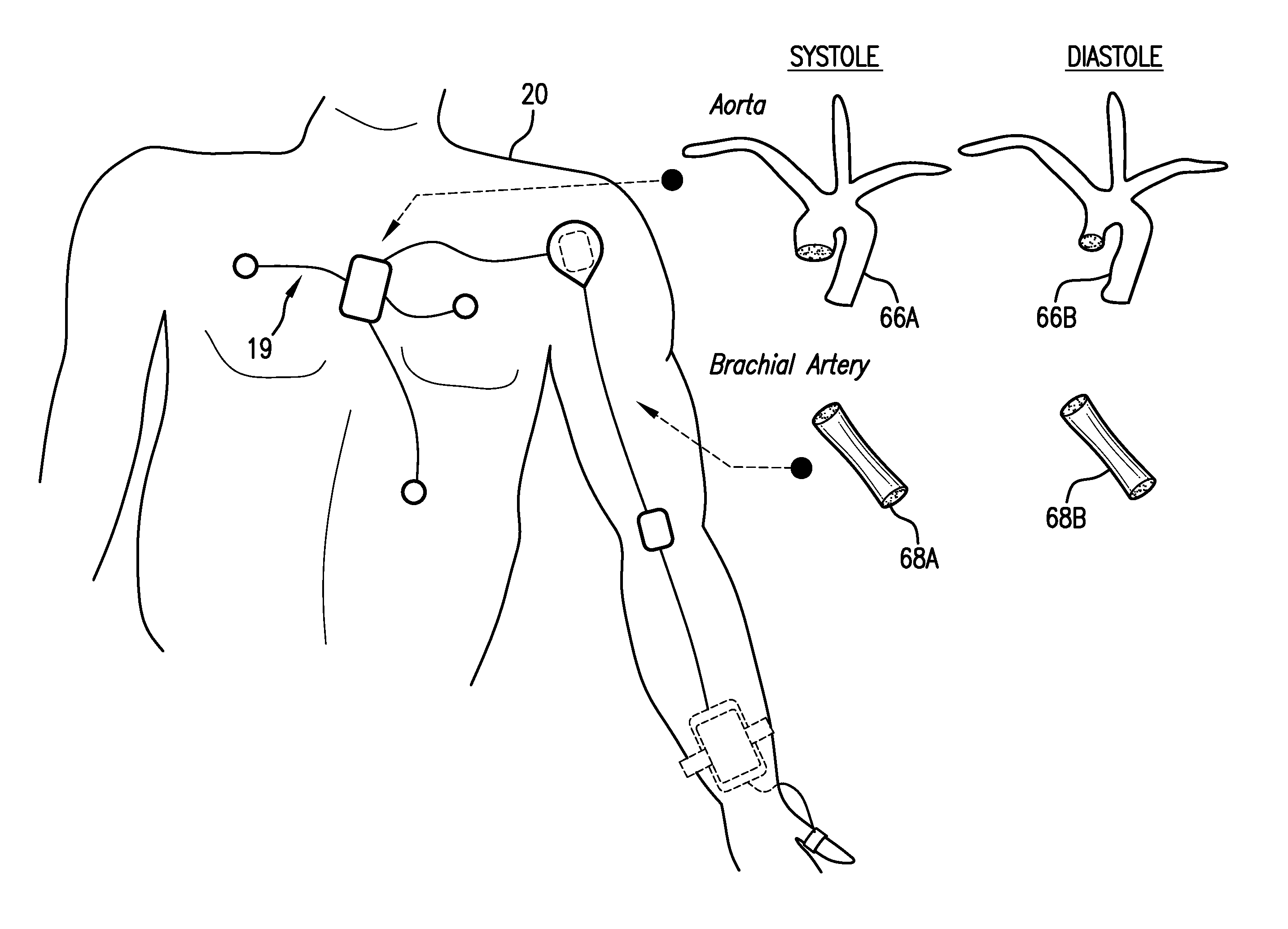 Body-worn system for continuous, noninvasive measurement of cardiac output, stroke volume, cardiac power, and blood pressure