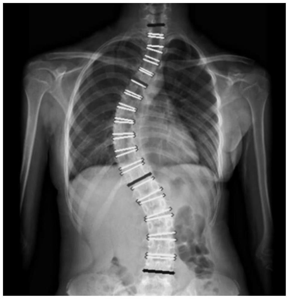 Method and system for measuring scoliosis Cobb angle by using oscillogram