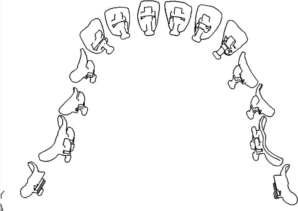 Manufacture method of individual orthodontic appliance for tongue