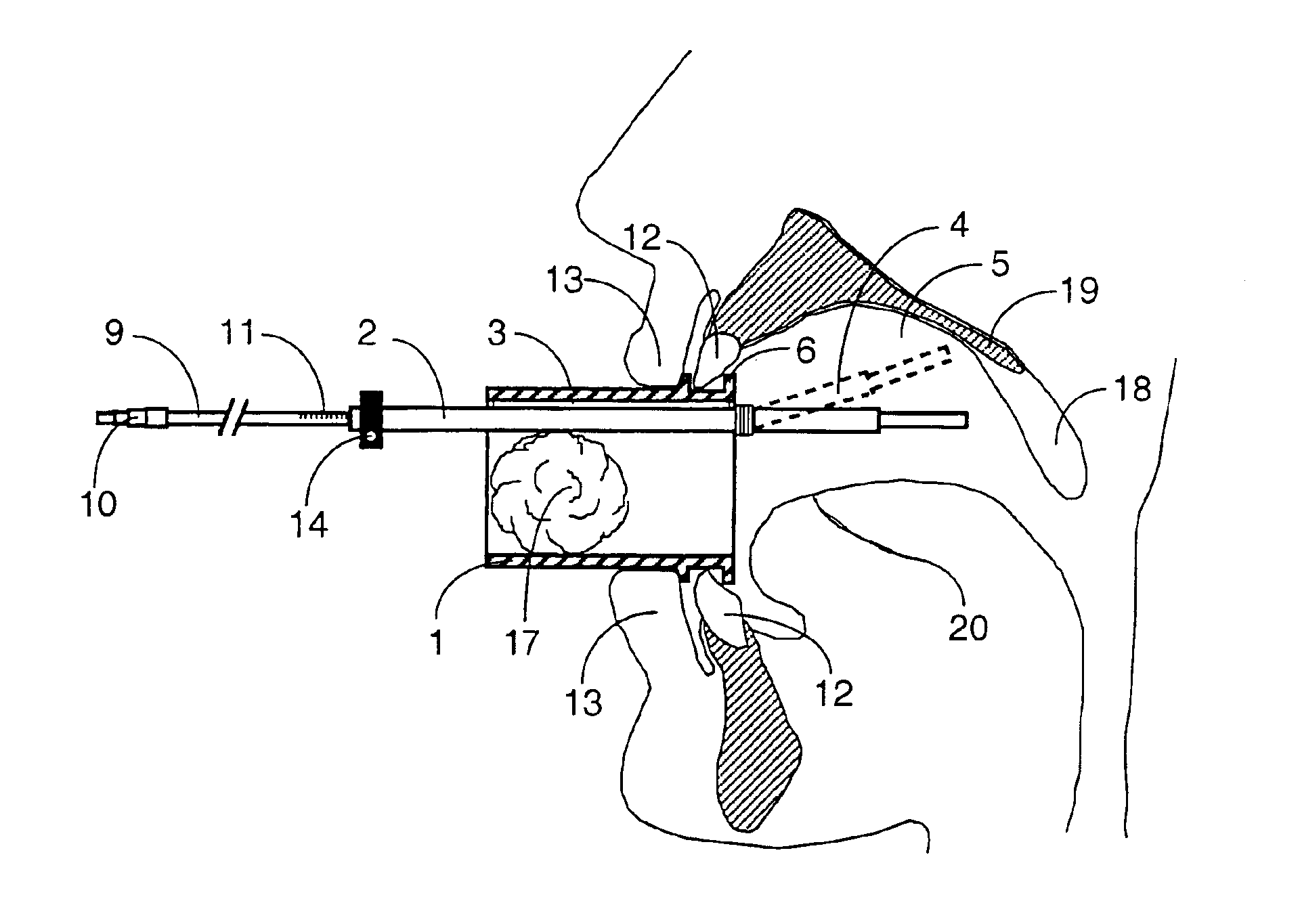 Mouthpiece intended for a device used to assess the sensitivity of the pharynx and a device comprising same