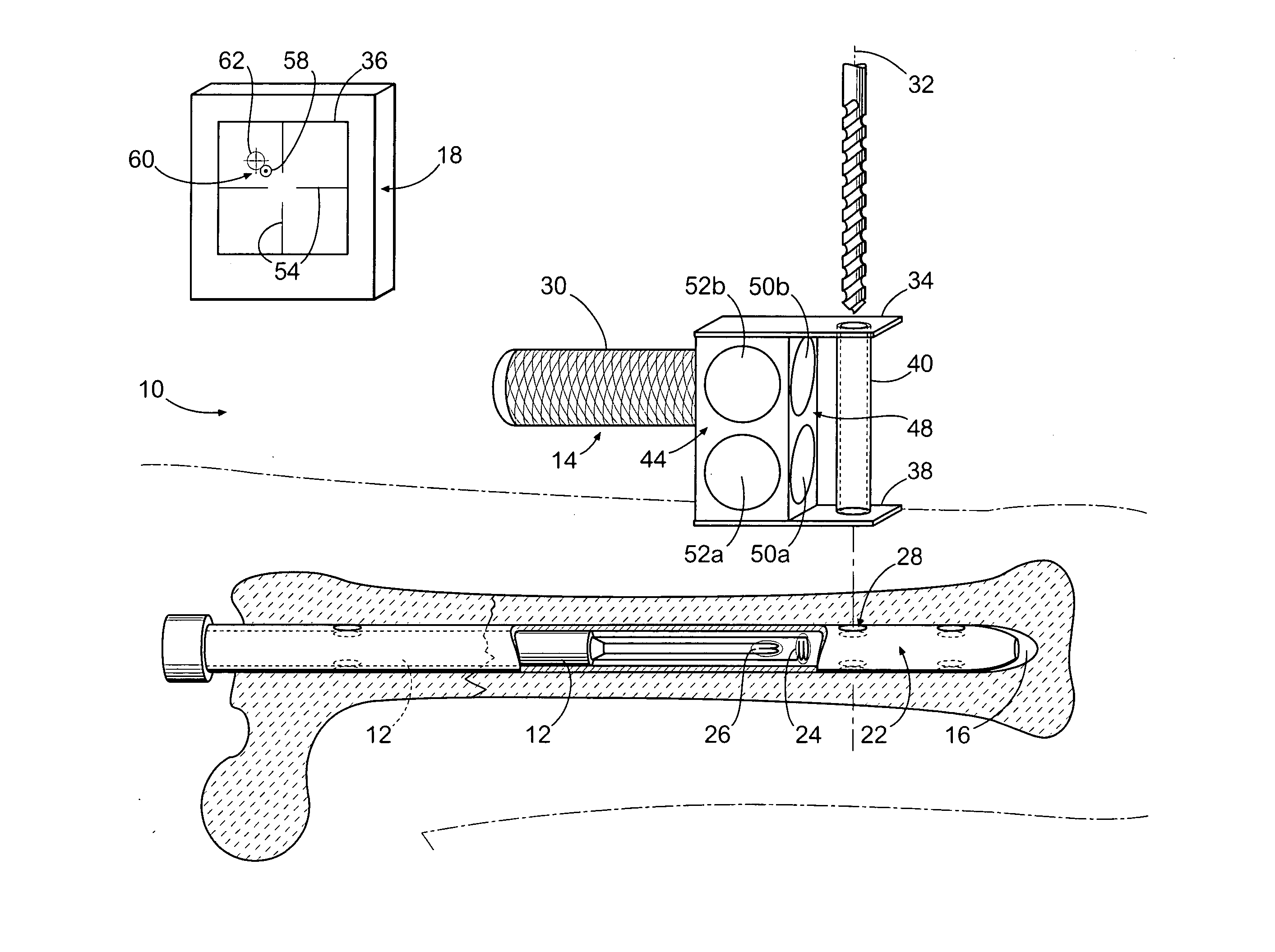 Method and apparatus for distal targeting of locking screws in intramedullary nails