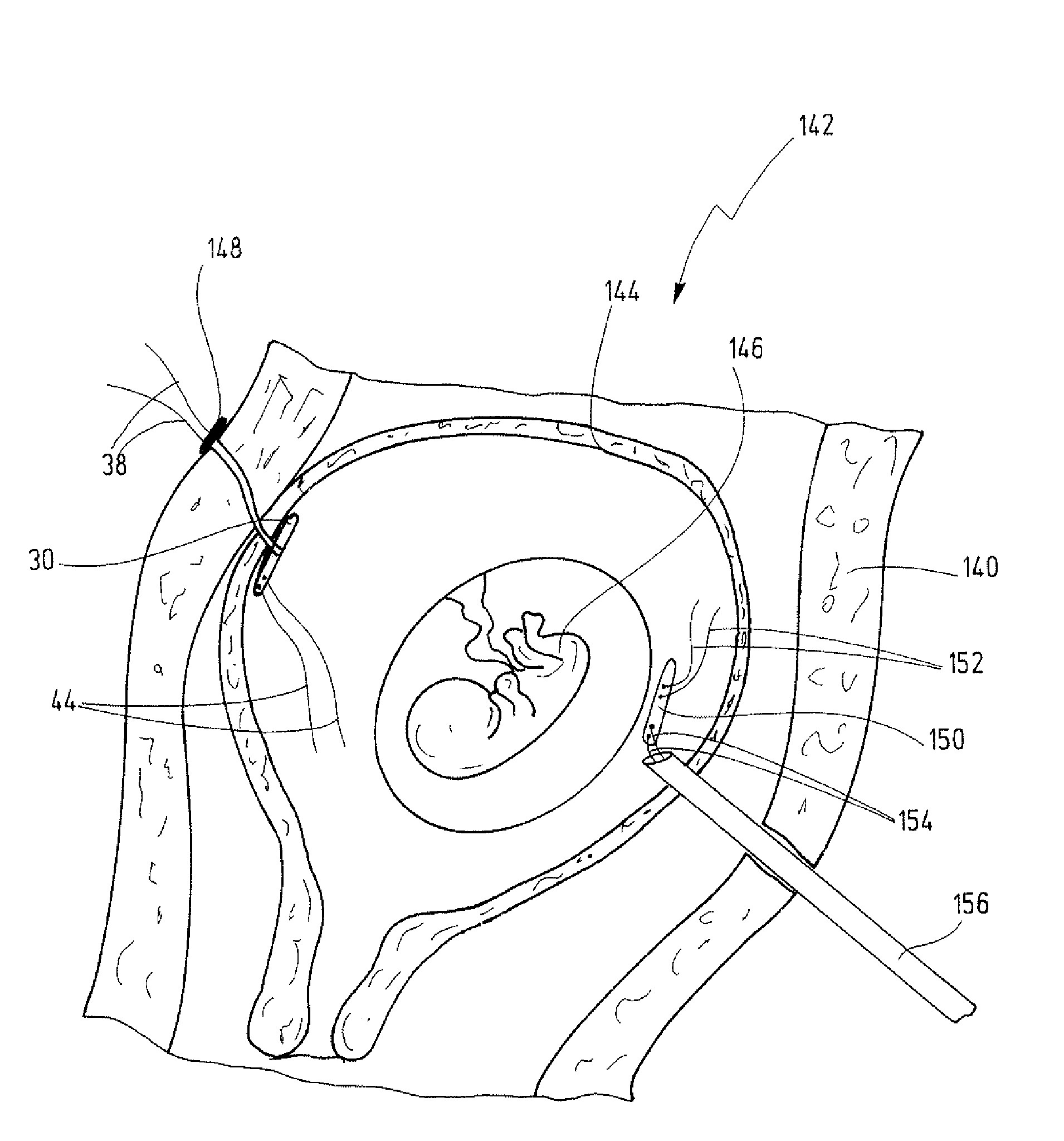 Device For Inserting At Least One Anchor Piece Into A Hollow Space Of A Living Being