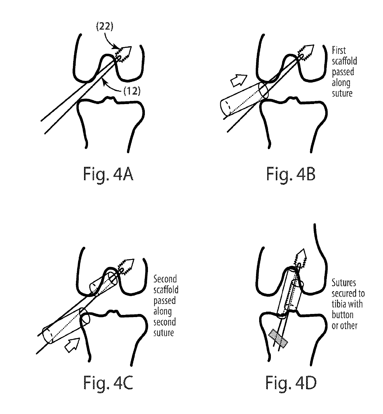 Indirect method of articular tissue repair