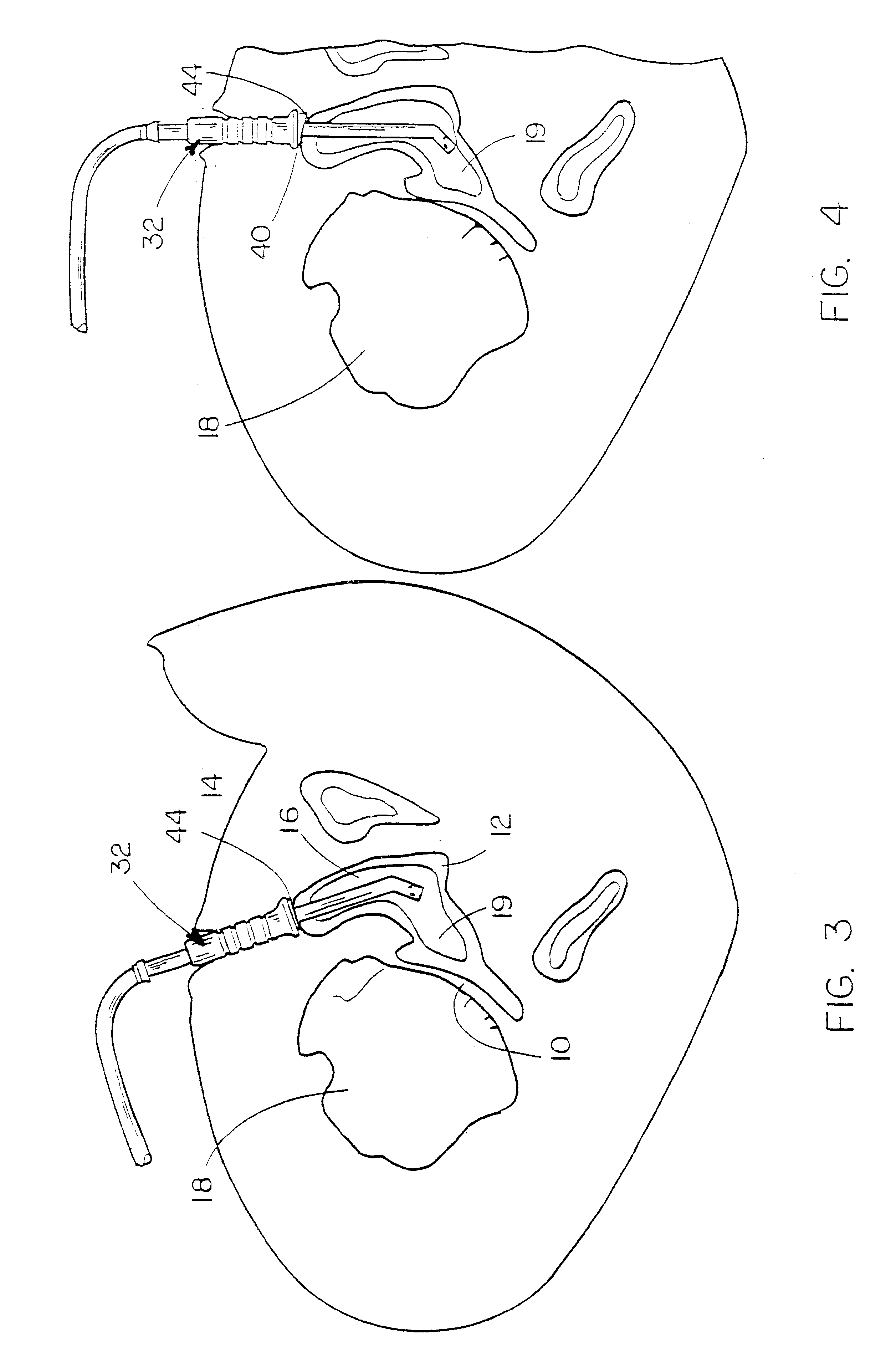 Method and means for cementing a liner onto the face of the glenoid cavity of a scapula