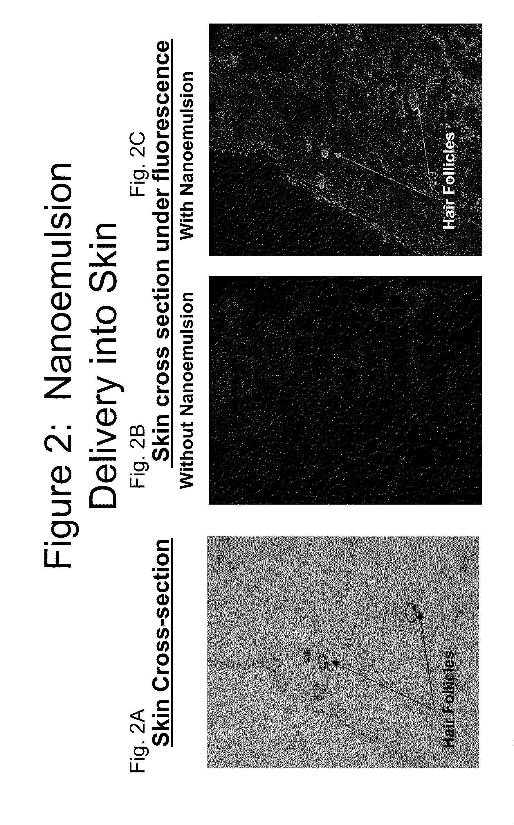 Methods and compositions for treating onchomycosis