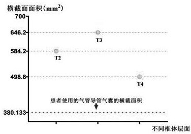 Tracheal catheter air bag accurate matching method for patient airway