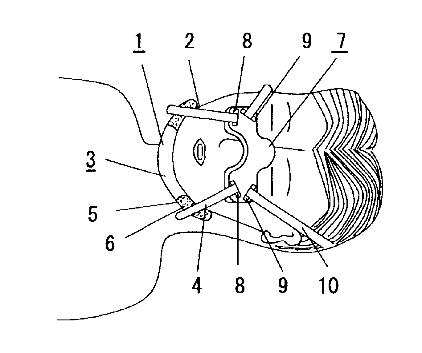 Device for preventing sleep apnea