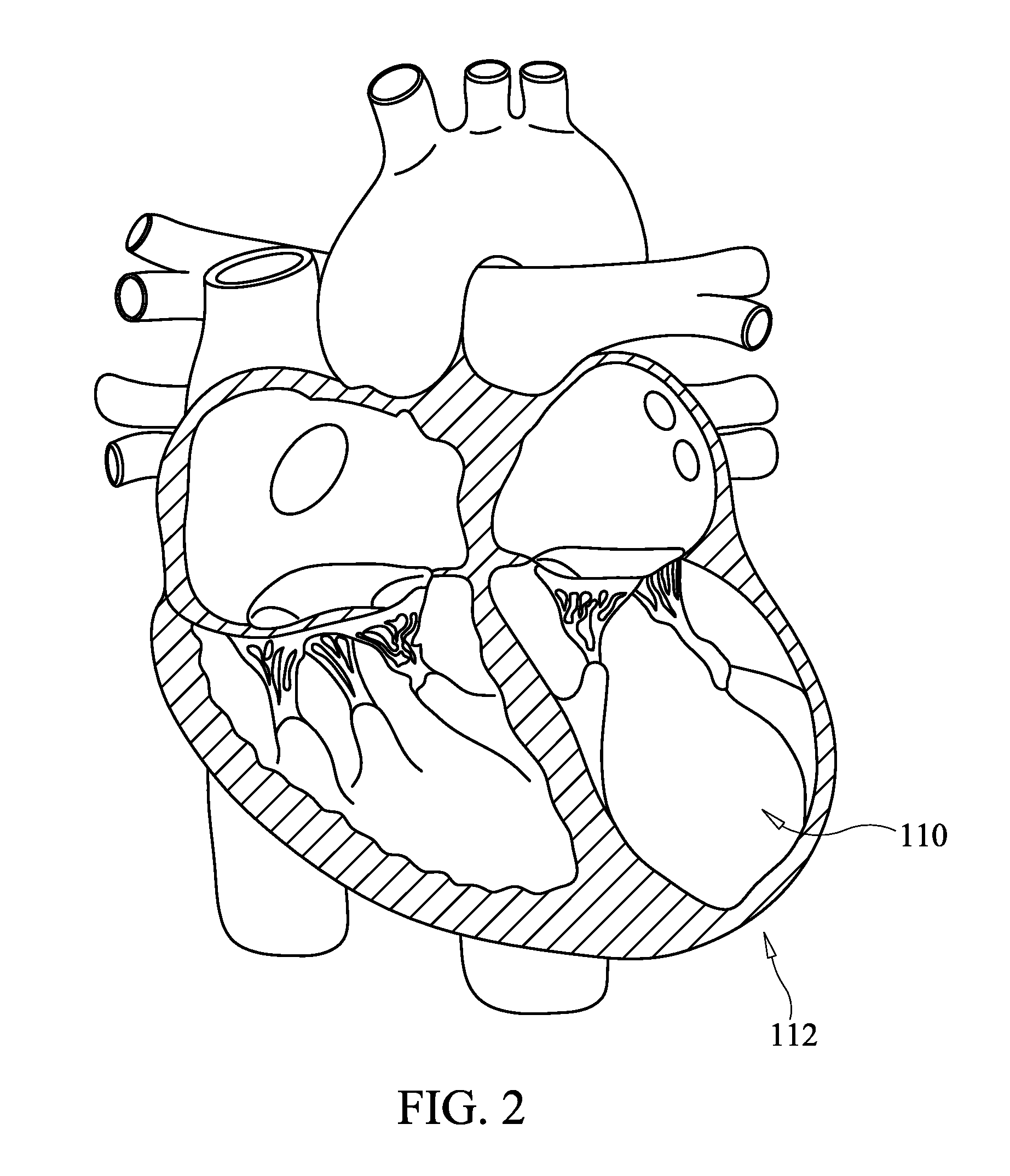 Method for percutaneous lateral access to the left ventricle for treatment of mitral insufficiency by papillary muscle alignment