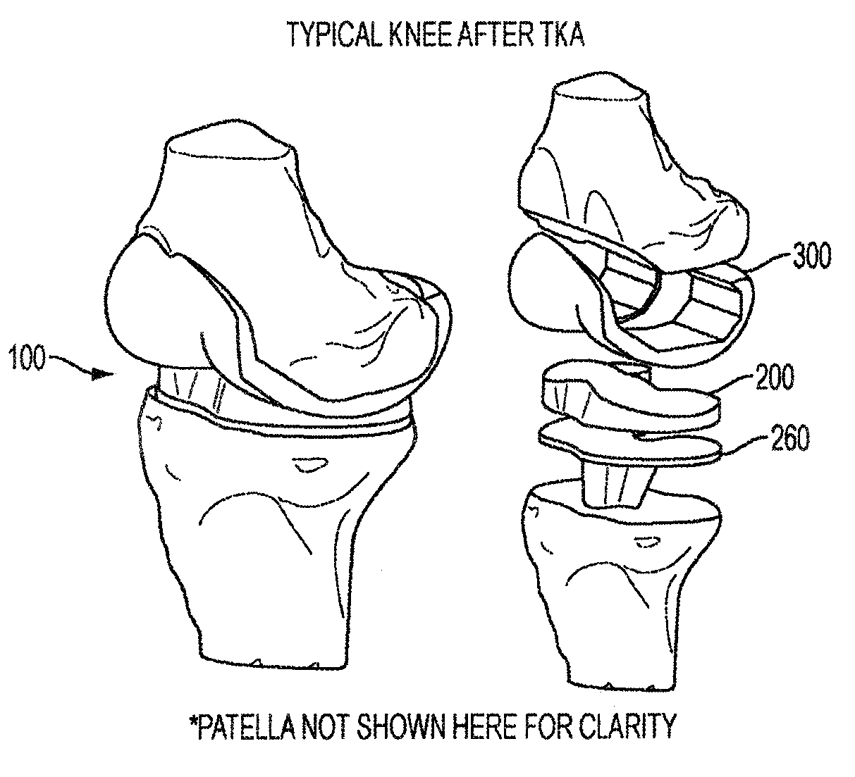 Implant for restoring normal range flexion and kinematics of the knee