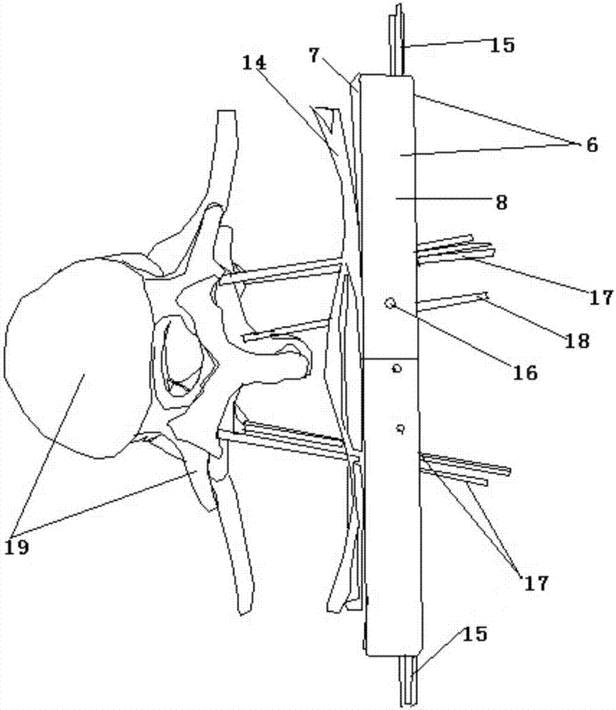Detachable skin-outer minimally invasive pedicle screw navigation device in combination with perspective