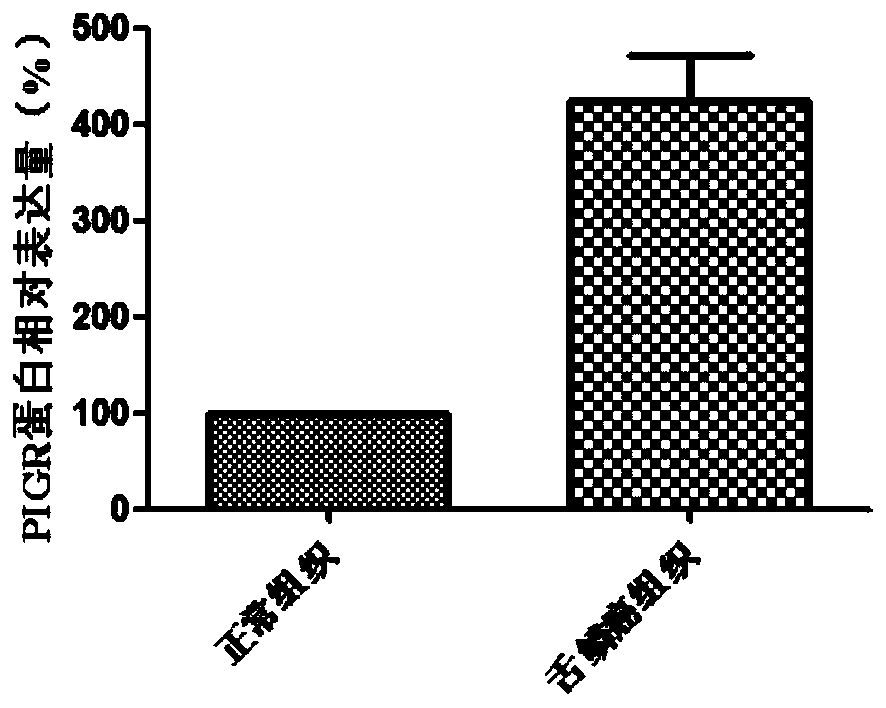 Diagnosis and treatment markers of tongue squamous cell carcinoma