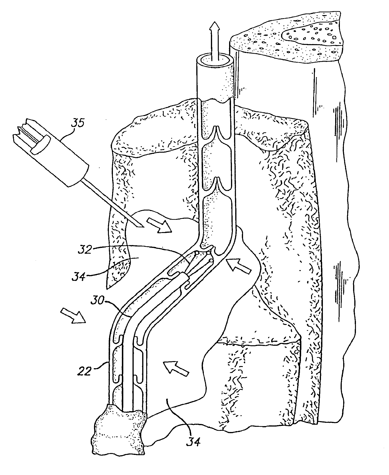 Method and apparatus for applying energy to biological tissue including the use of tumescent tissue compression