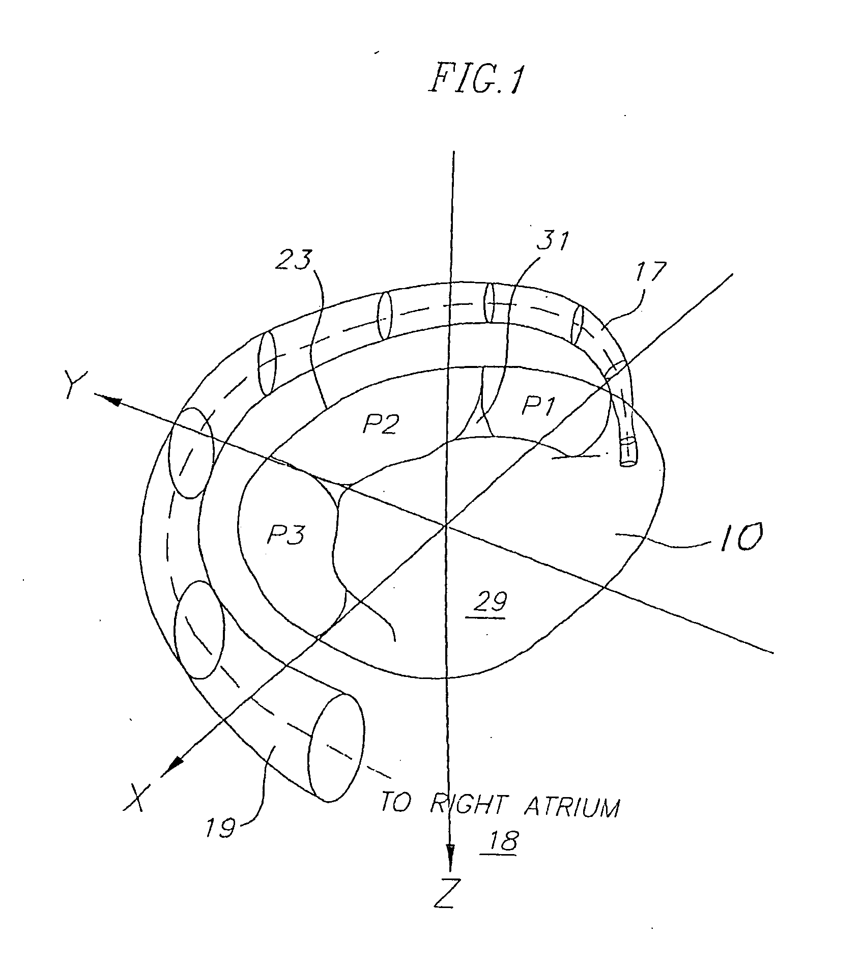 Anchoring system for medical implant