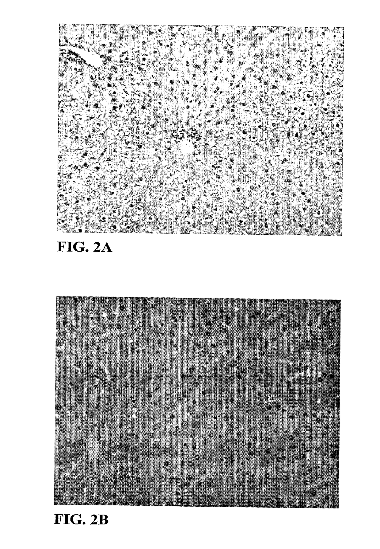 Thyromimetics for the Treatment of Fatty Liver Diseases