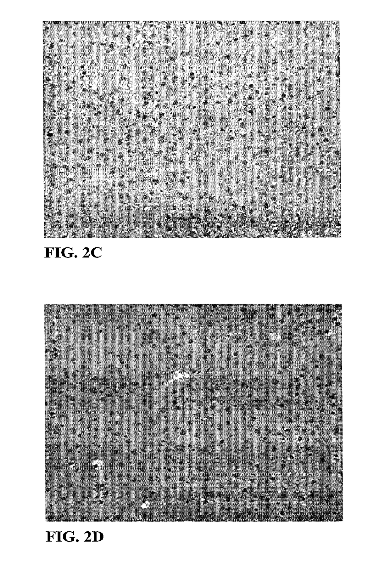 Thyromimetics for the Treatment of Fatty Liver Diseases