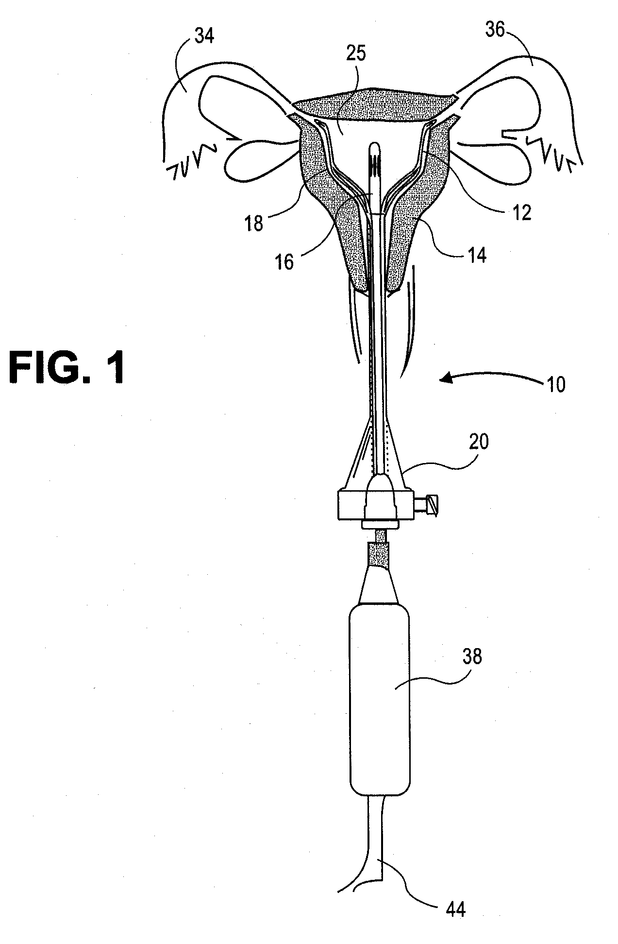 Uterine Therapy Device and Method