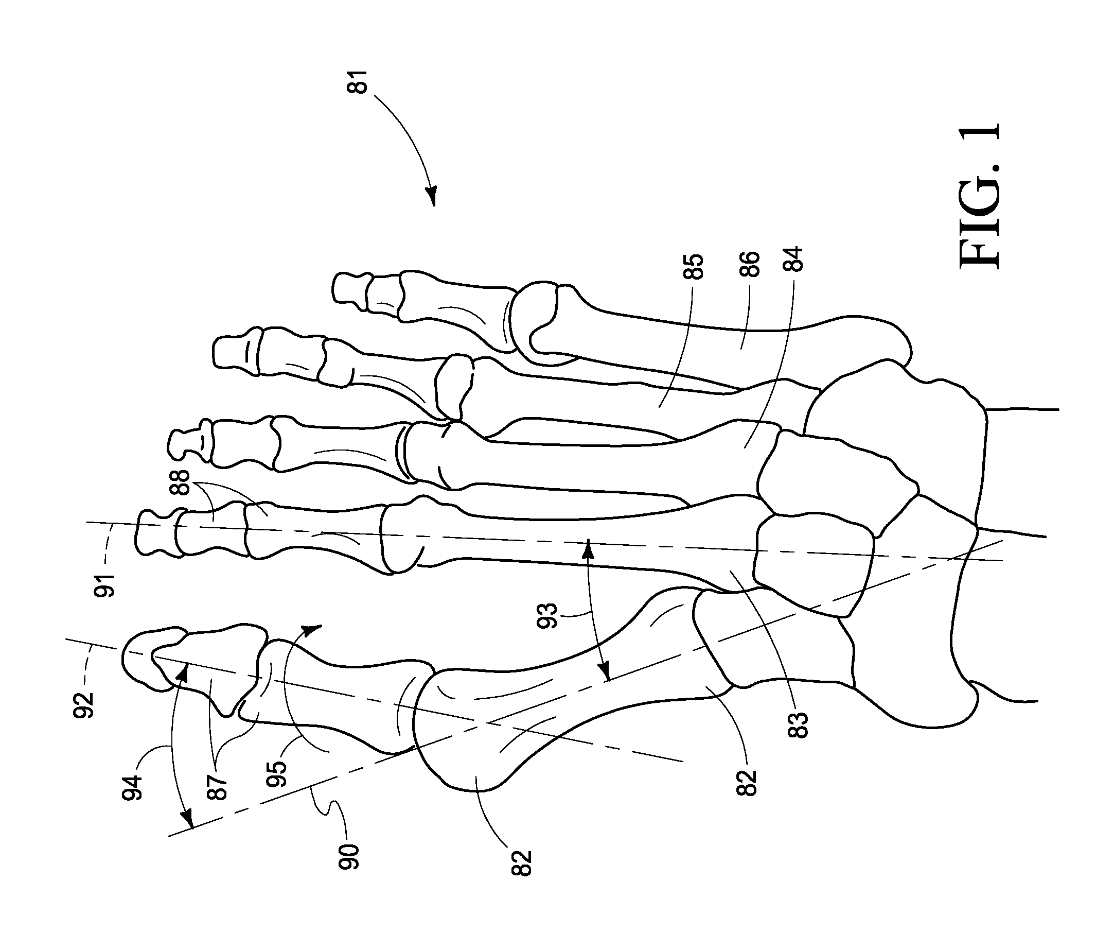 Combined Intramedullary - Extramedullary Bone Stabilization and Alignment System